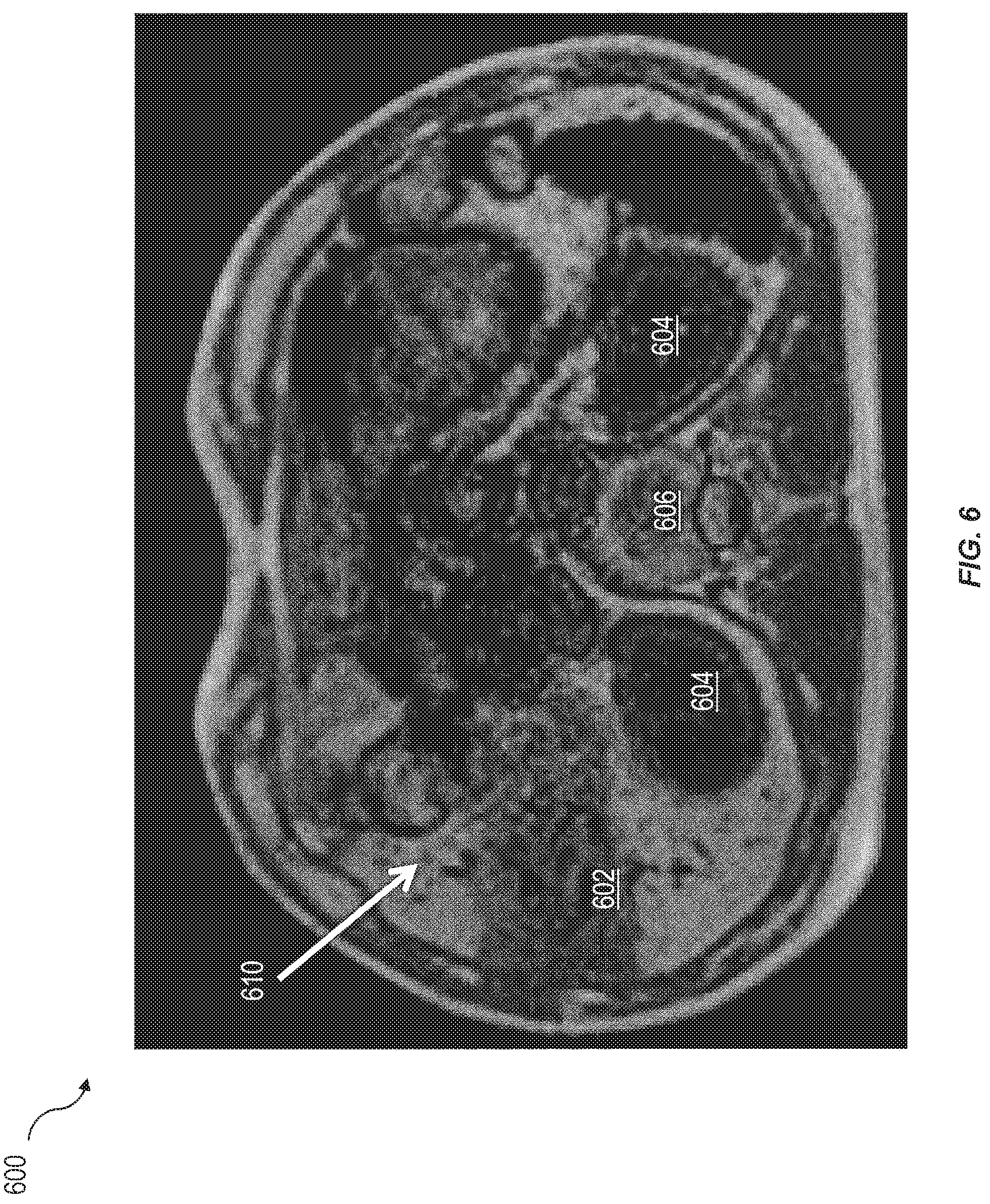 Patent US12090343 Figure 6 – Assessment and improvement of treatment using imaging of physiological responses to radiation therapy