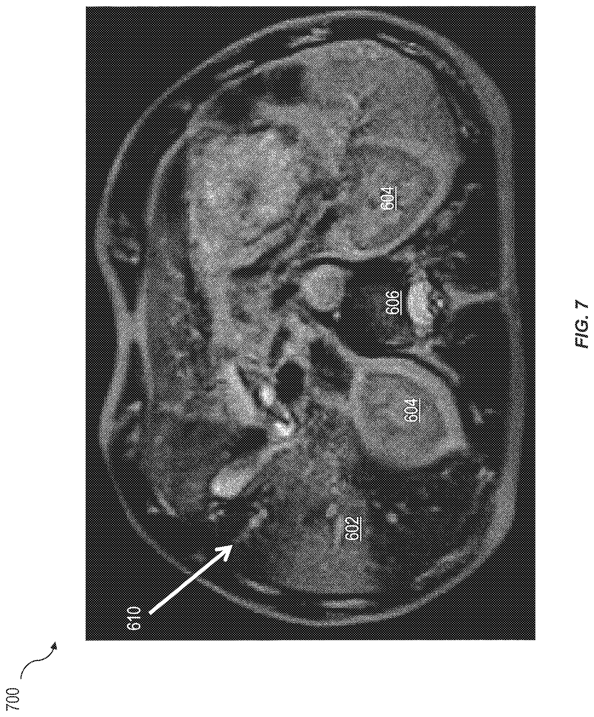 Patent US12090343 Figure 7 – Assessment and improvement of treatment using imaging of physiological responses to radiation therapy