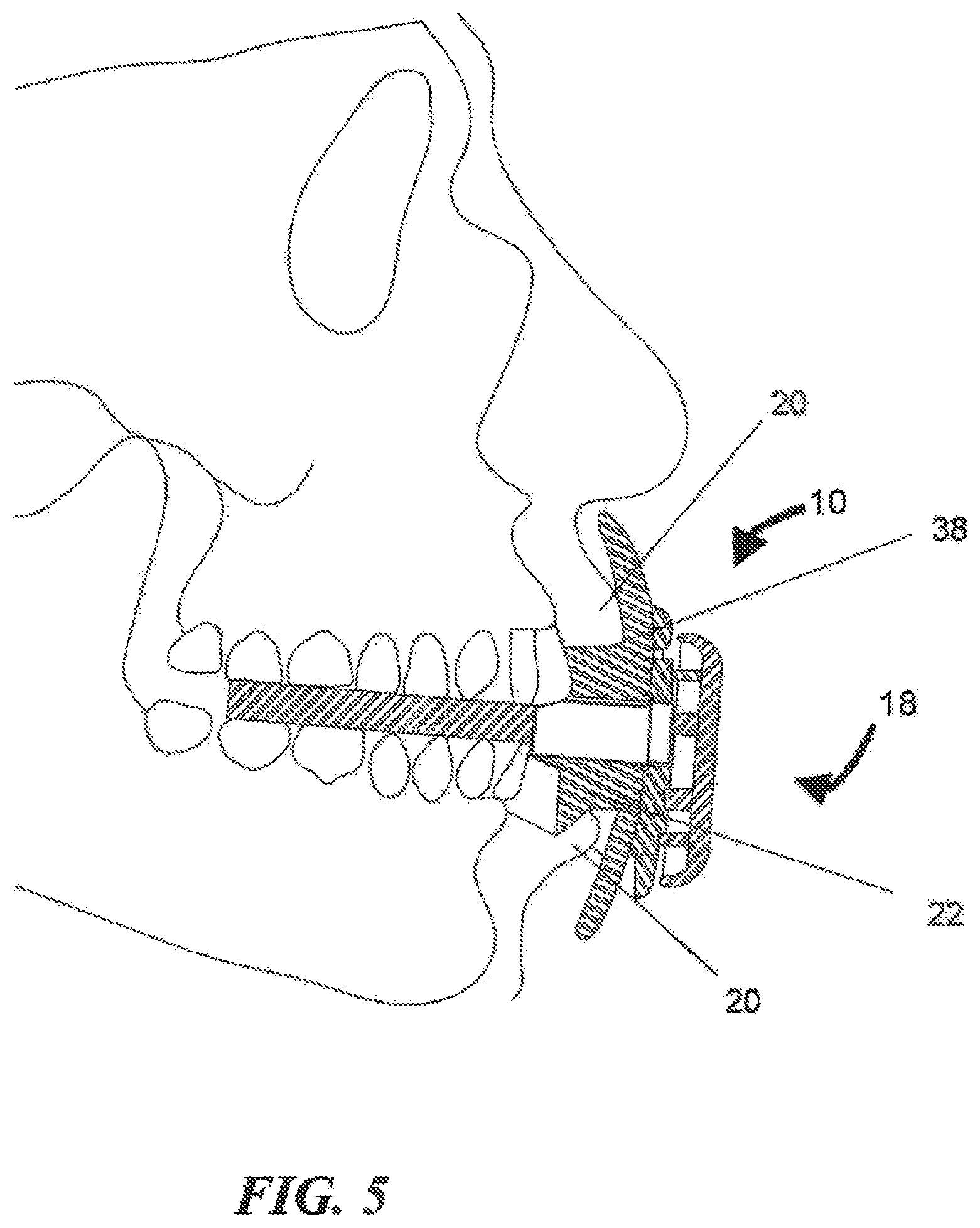 Patent US12090385 Figure 3 – Cardiorespiratory fitness optimizer apparatus