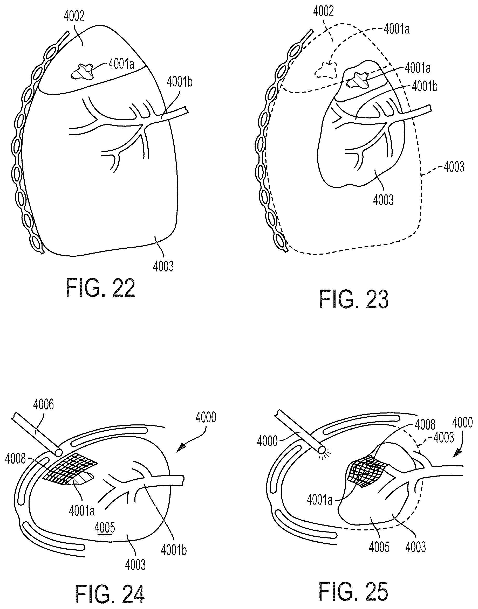 Patent US12092738 Figure 17 – Surgical visualization system for generating and updating a three-dimensional digital representation from structured light imaging data