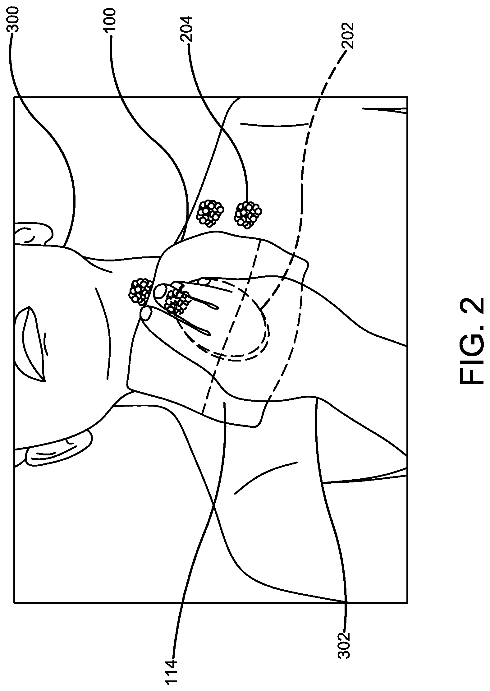 Patent US12096893 Figure 2 – Pouched washcloth for storing a soap bar