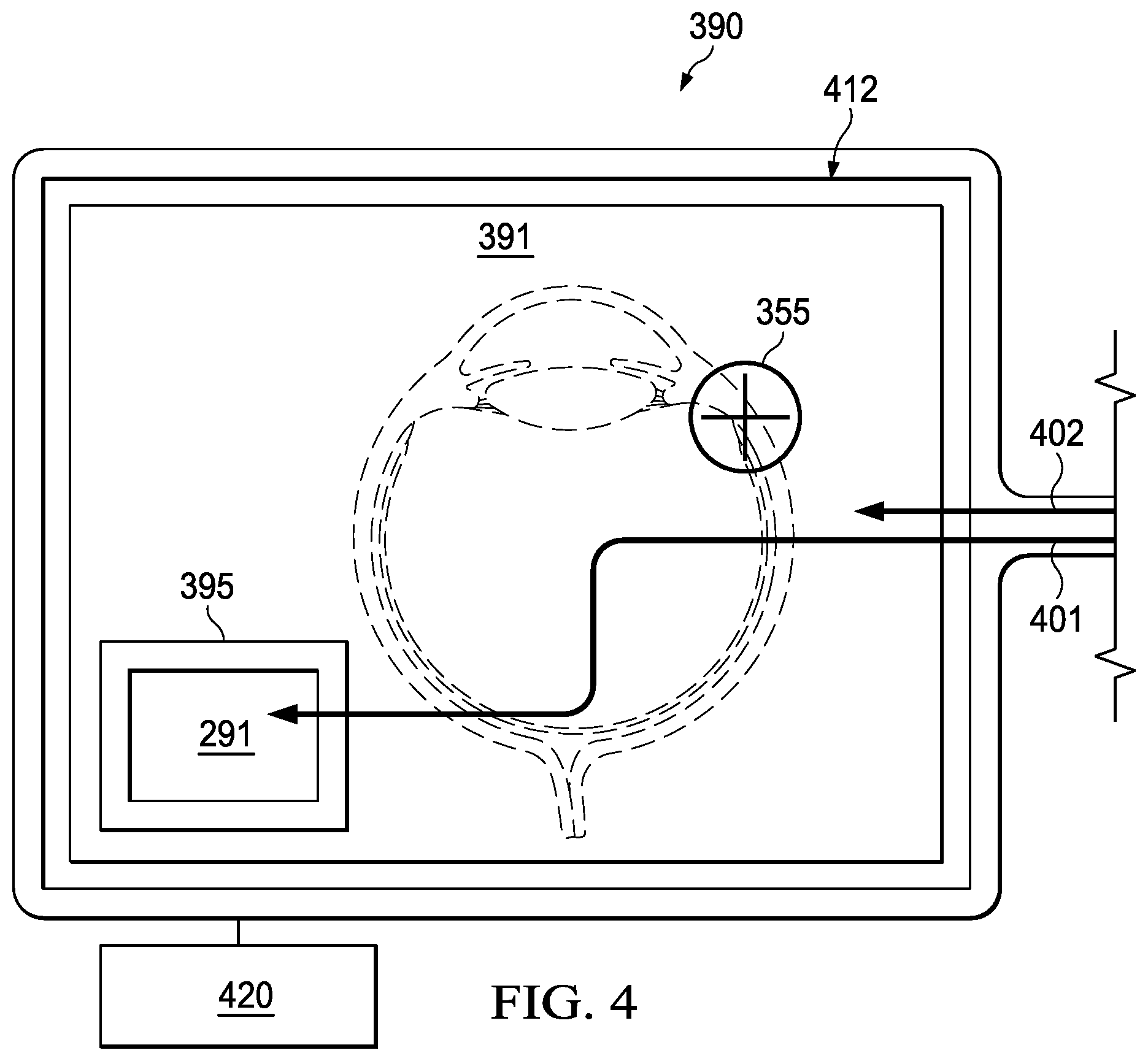Patent US12096917 Figure 5 – Tip camera systems and methods for vitreoretinal surgery