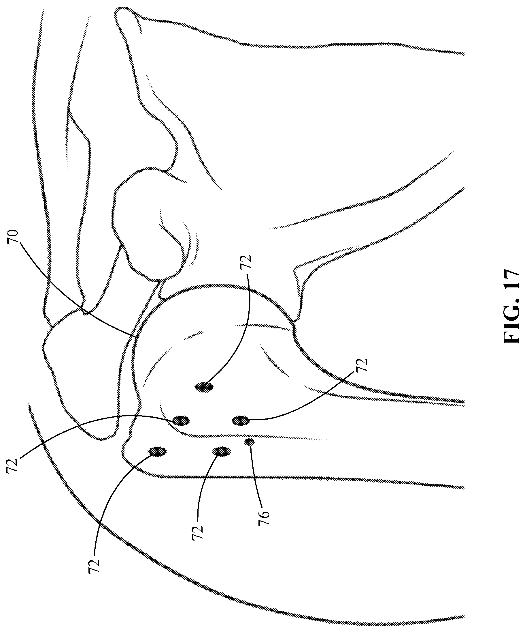 Patent US12096927 Figure 9 – Suture tensioning and securement device, system, and methods
