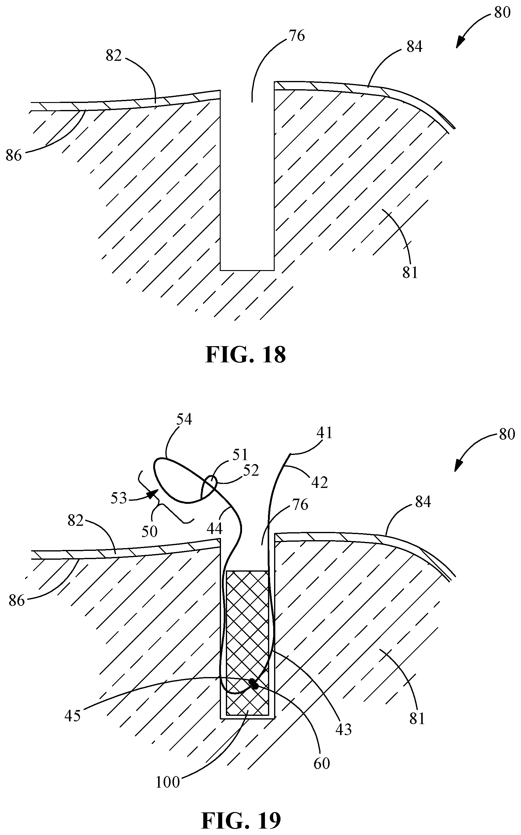 Patent US12096927 Figure 10 – Suture tensioning and securement device, system, and methods