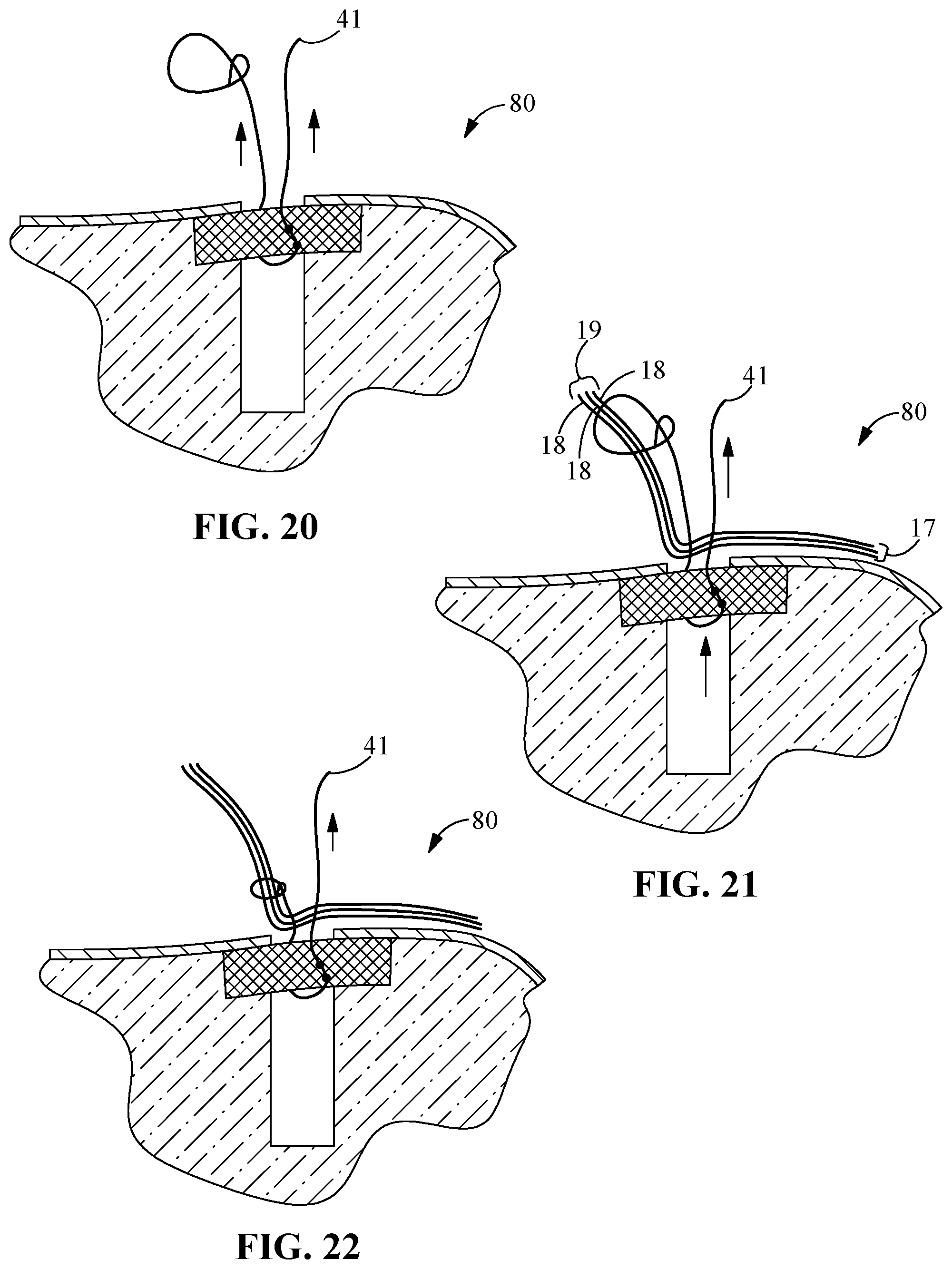 Patent US12096927 Figure 11 – Suture tensioning and securement device, system, and methods