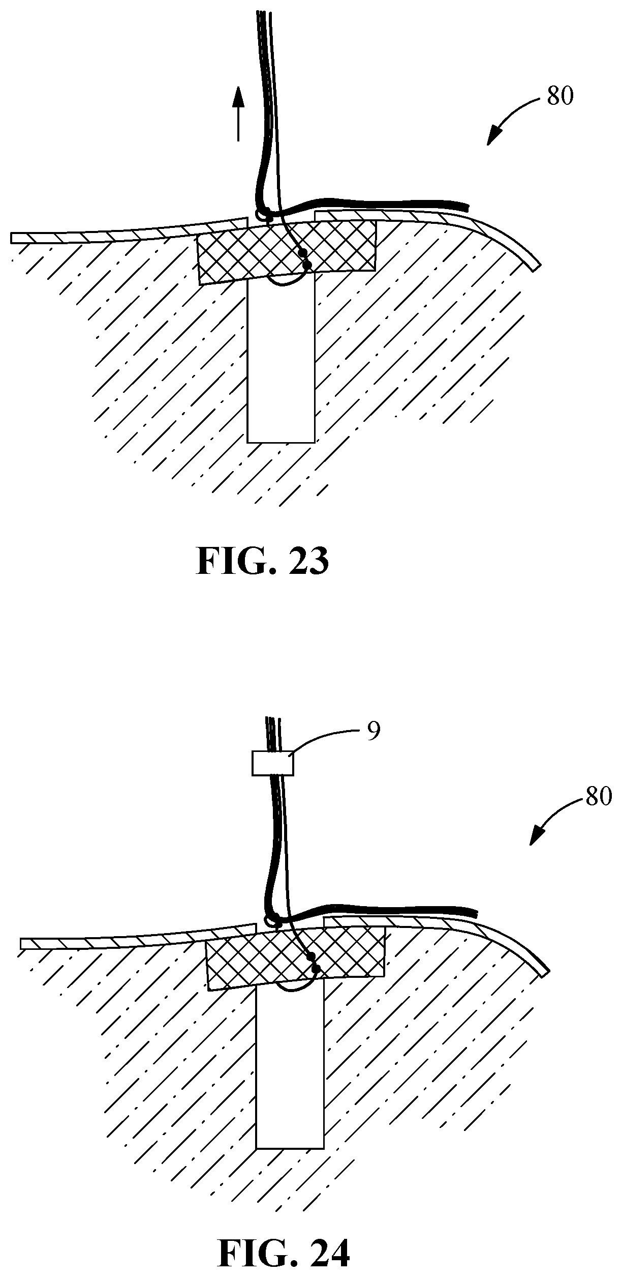Patent US12096927 Figure 12 – Suture tensioning and securement device, system, and methods