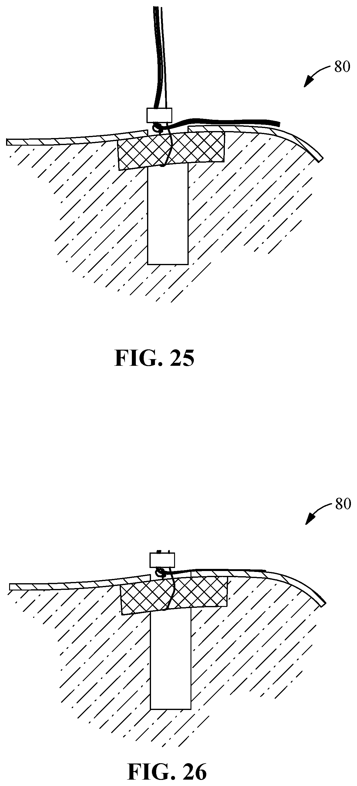 Patent US12096927 Figure 13 – Suture tensioning and securement device, system, and methods