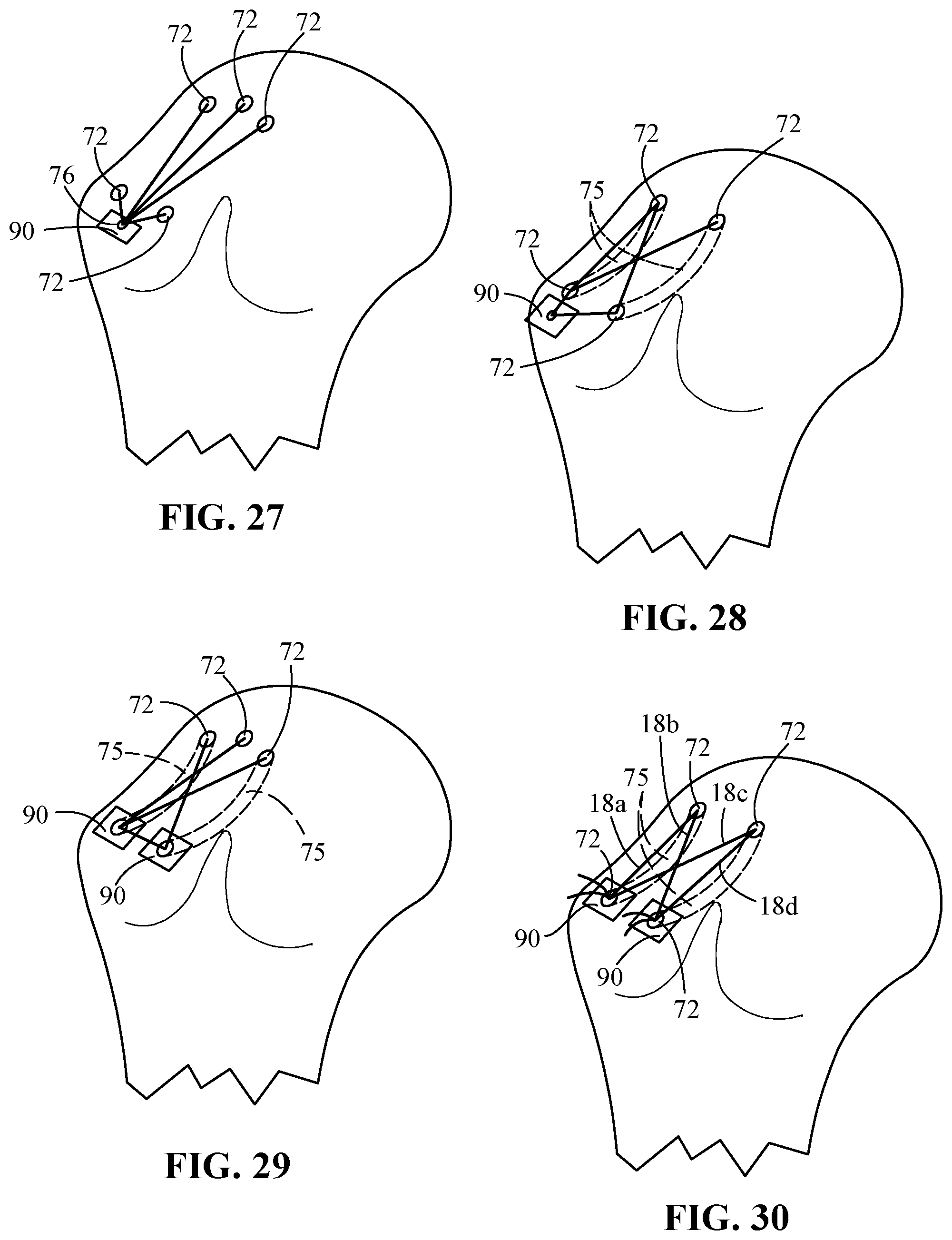 Patent US12096927 Figure 14 – Suture tensioning and securement device, system, and methods