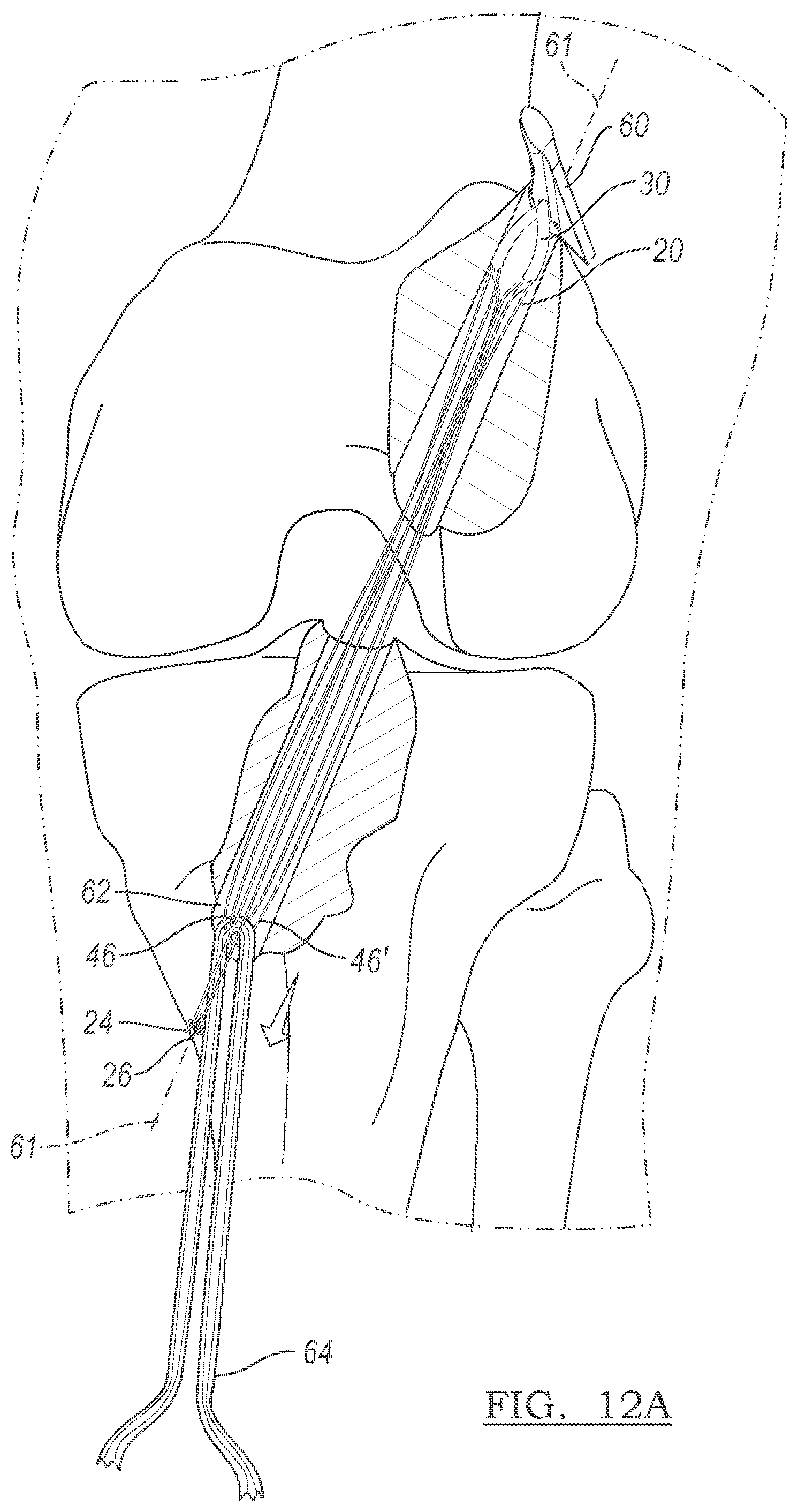 Patent US12096928 Figure 6 – Method and apparatus for coupling soft tissue to a bone