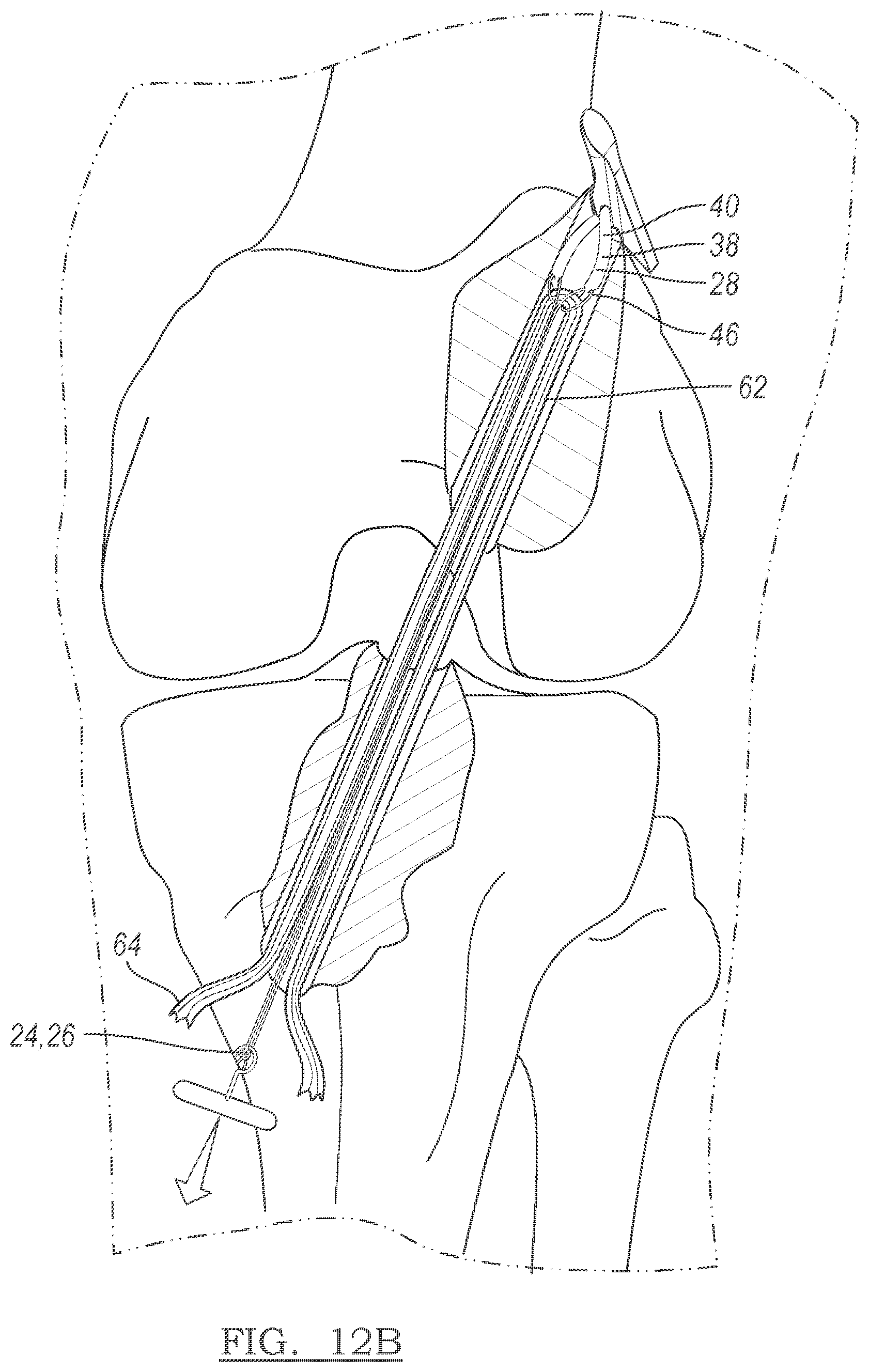 Patent US12096928 Figure 7 – Method and apparatus for coupling soft tissue to a bone
