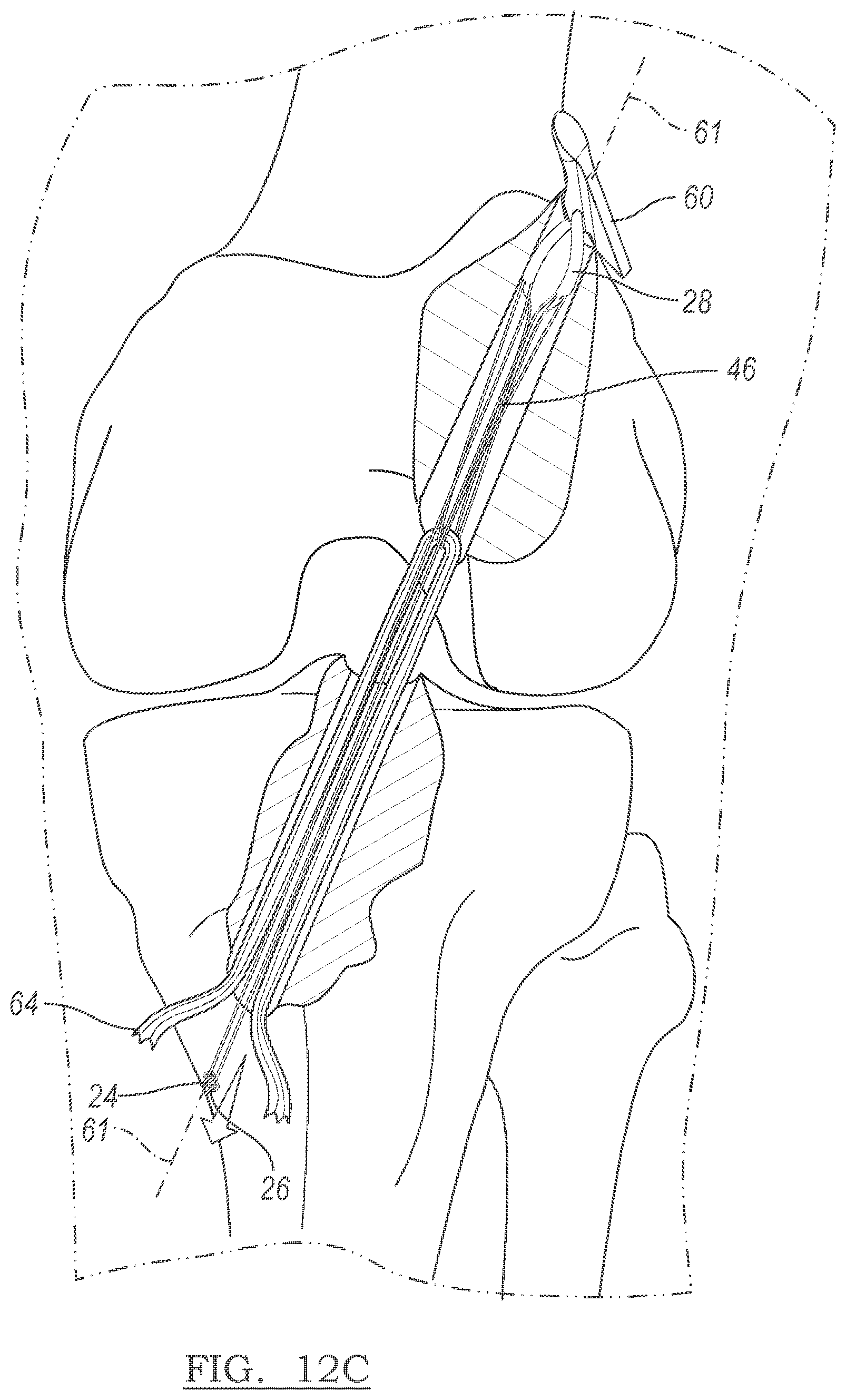 Patent US12096928 Figure 8 – Method and apparatus for coupling soft tissue to a bone