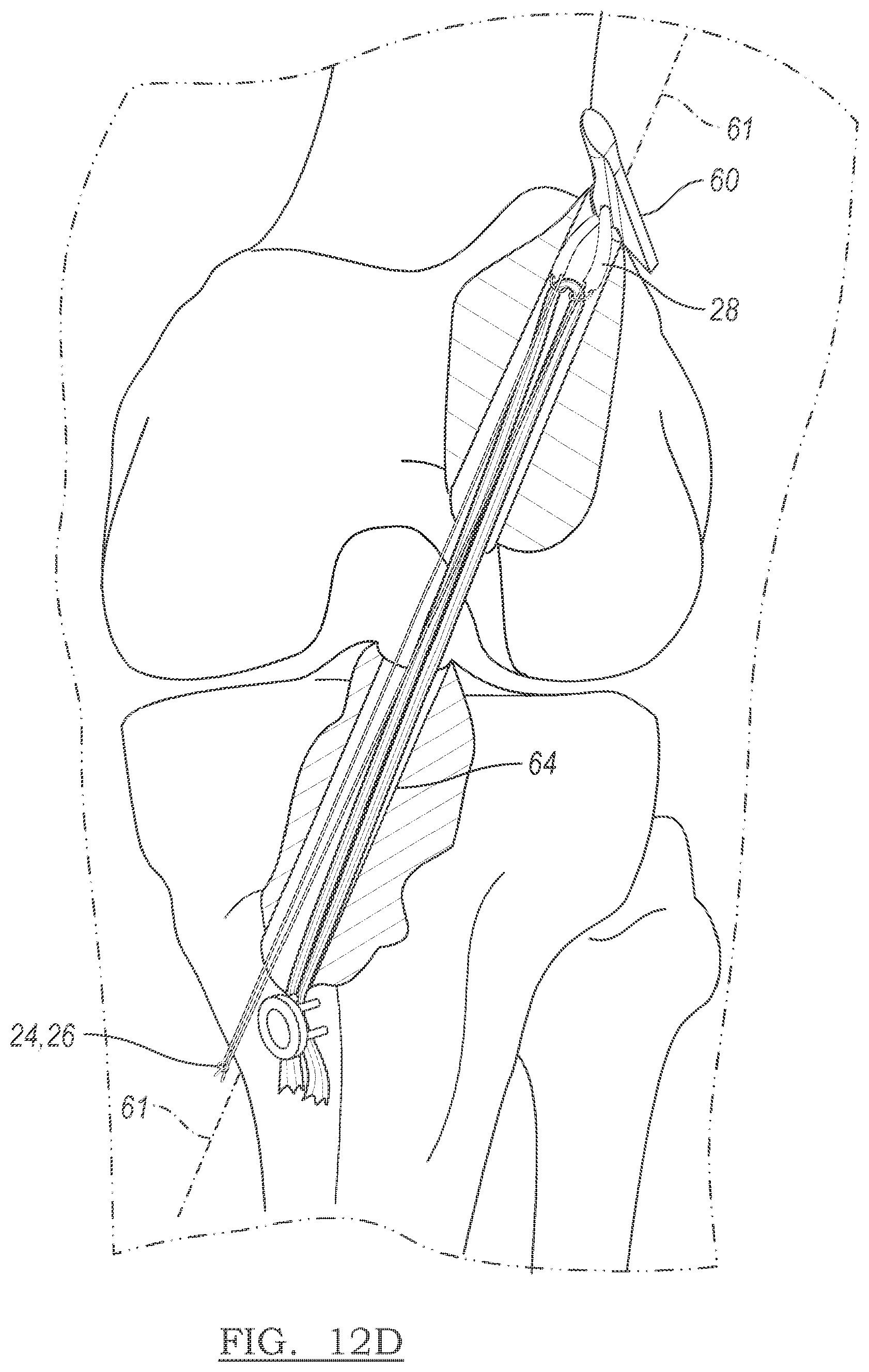 Patent US12096928 Figure 9 – Method and apparatus for coupling soft tissue to a bone