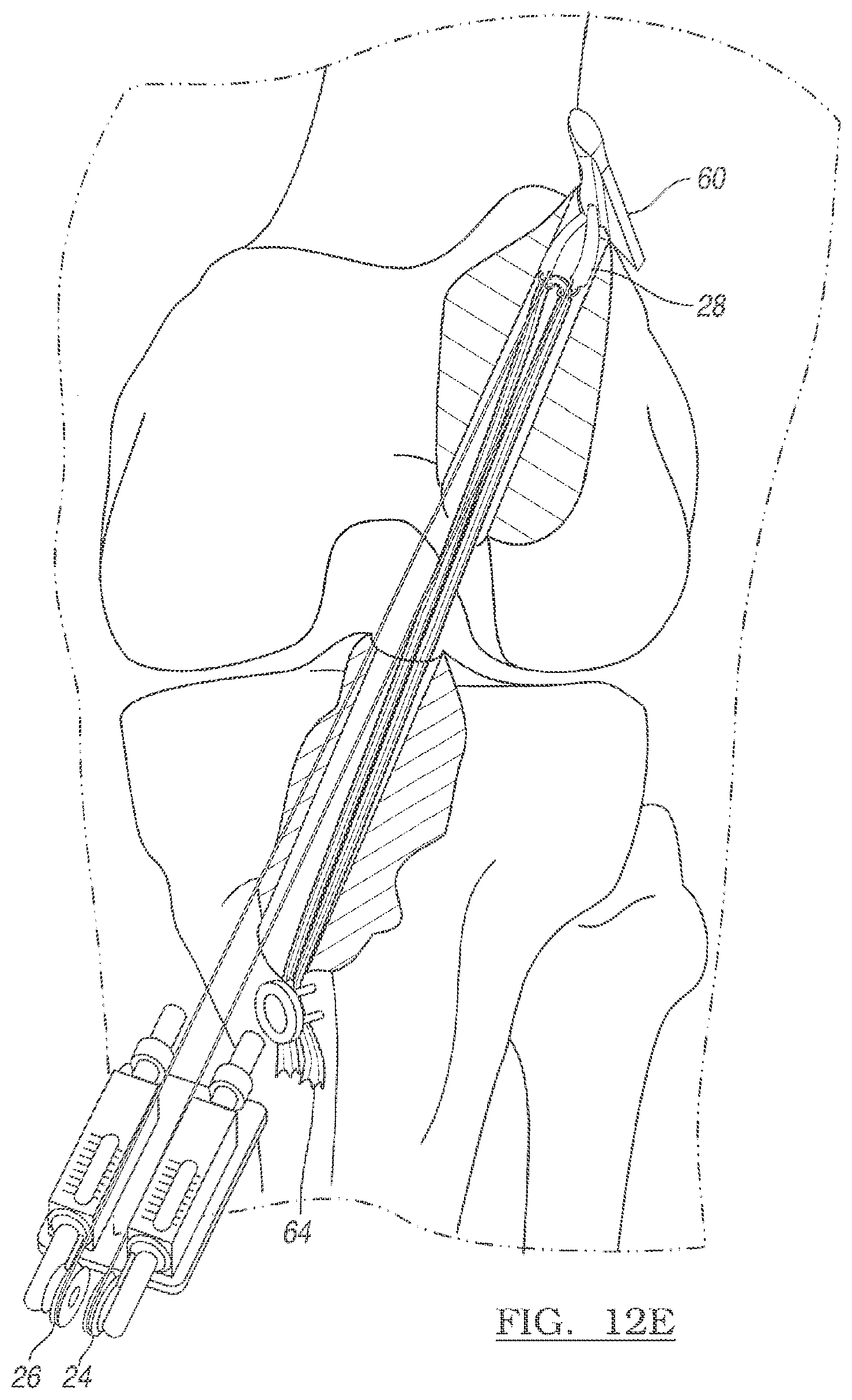 Patent US12096928 Figure 10 – Method and apparatus for coupling soft tissue to a bone