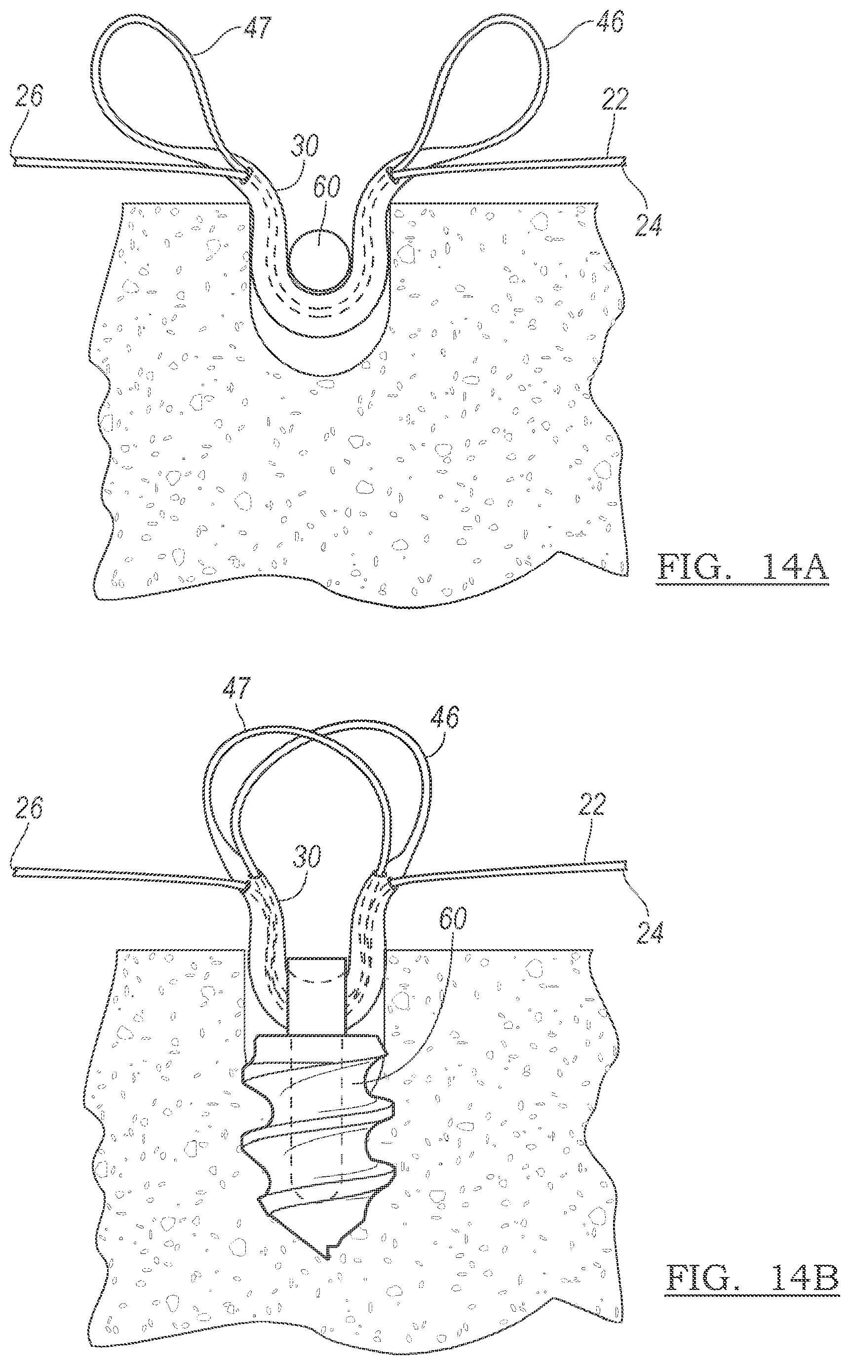 Patent US12096928 Figure 12 – Method and apparatus for coupling soft tissue to a bone