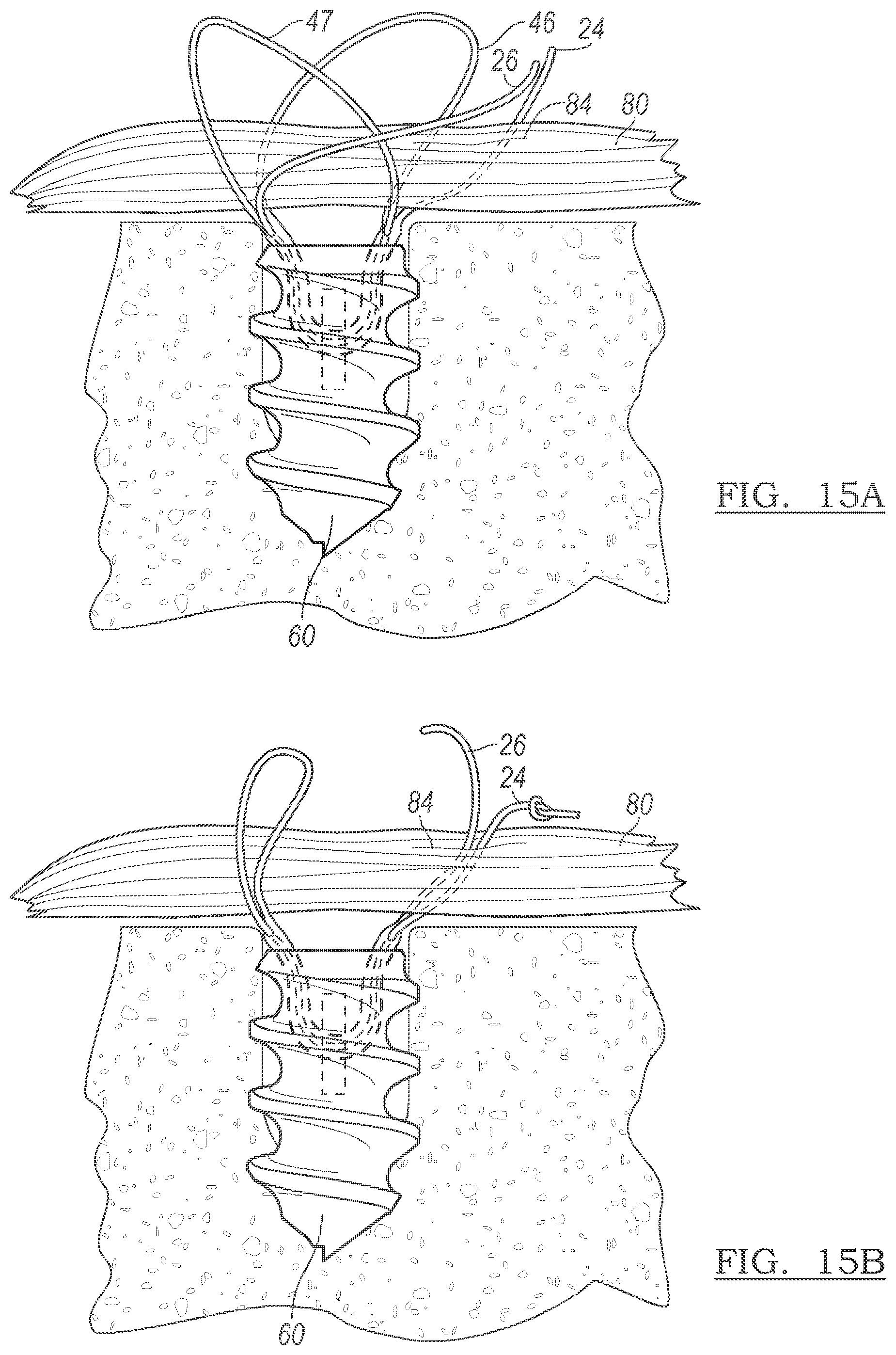 Patent US12096928 Figure 13 – Method and apparatus for coupling soft tissue to a bone