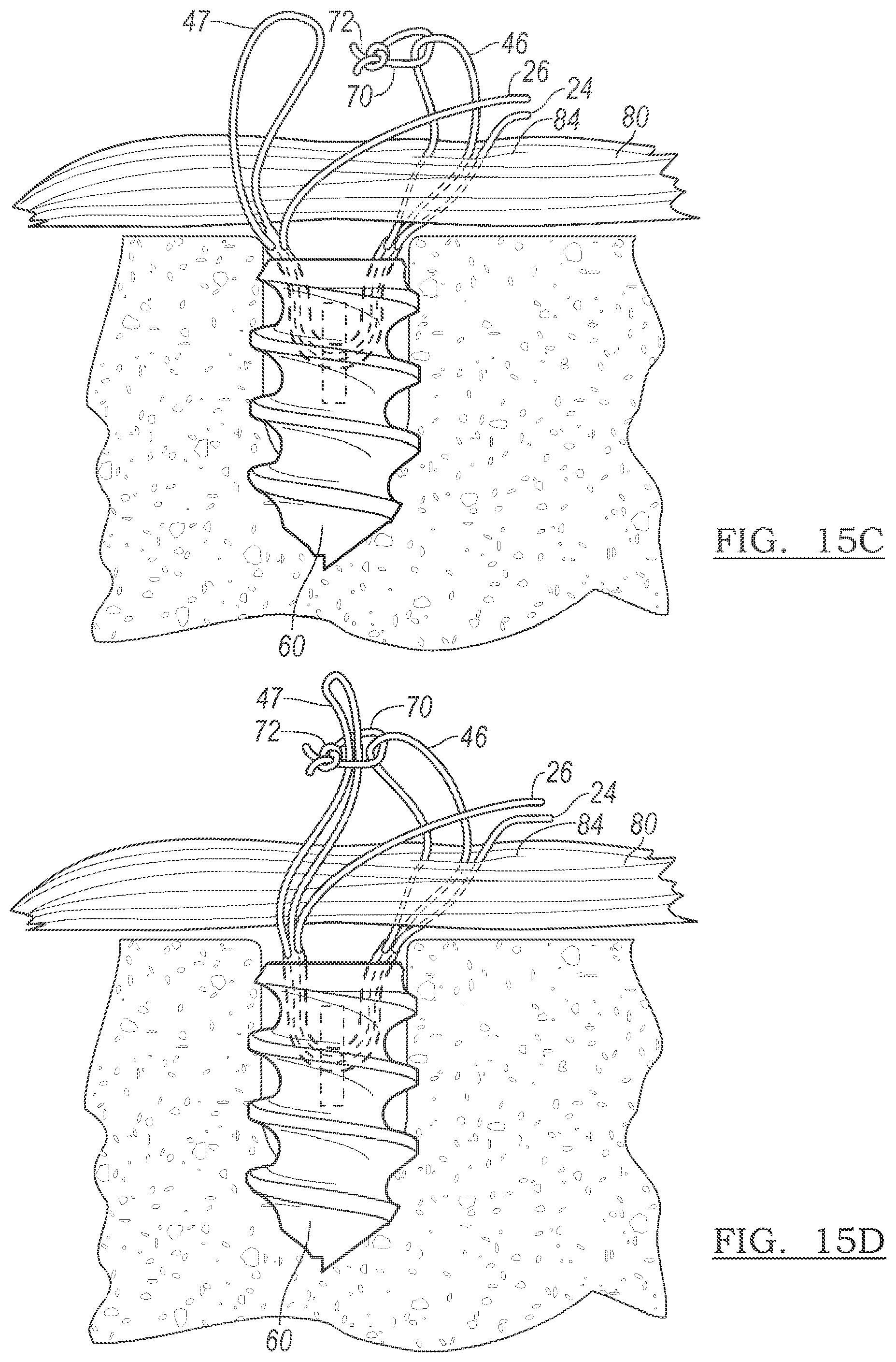 Patent US12096928 Figure 14 – Method and apparatus for coupling soft tissue to a bone