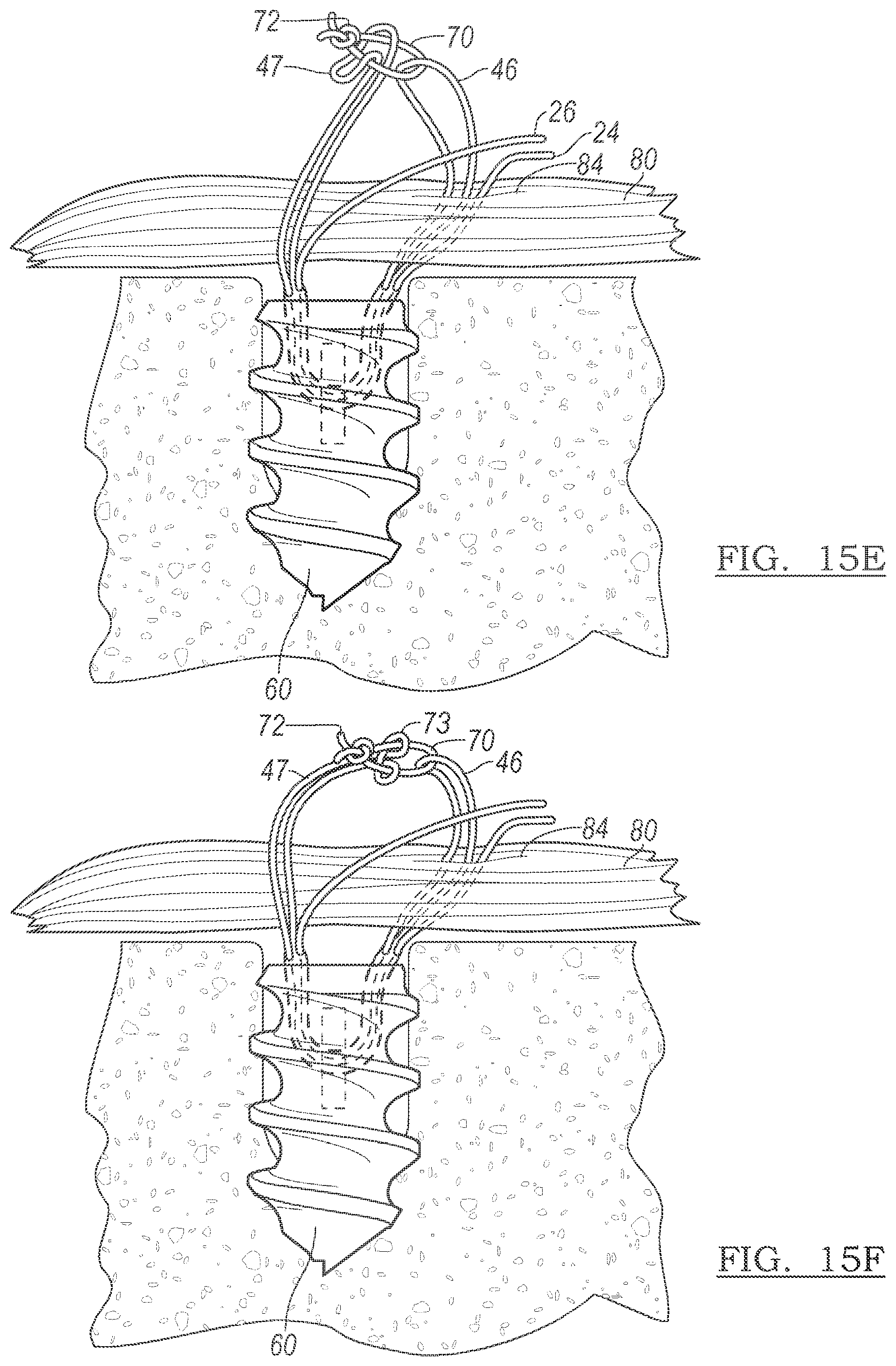 Patent US12096928 Figure 15 – Method and apparatus for coupling soft tissue to a bone