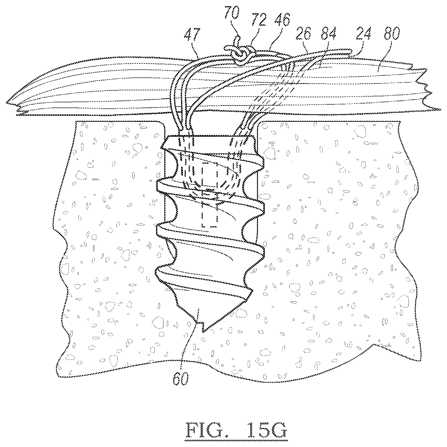 Patent US12096928 Figure 16 – Method and apparatus for coupling soft tissue to a bone