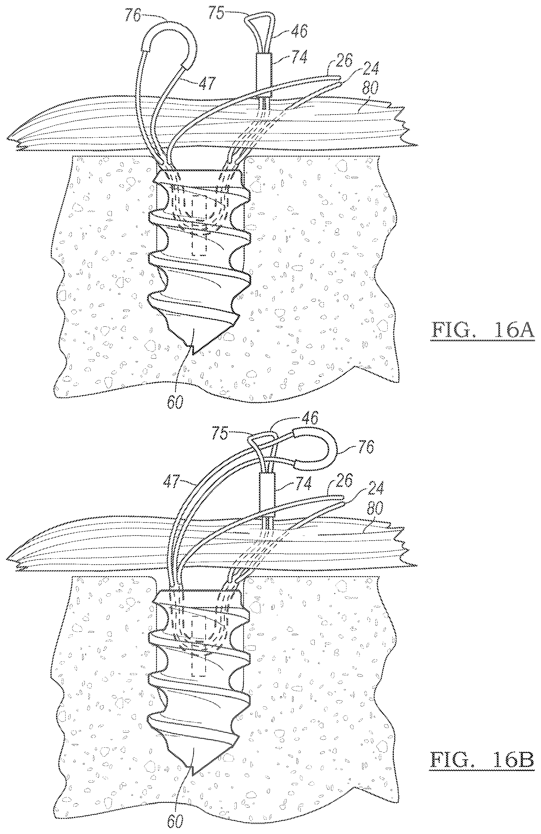 Patent US12096928 Figure 17 – Method and apparatus for coupling soft tissue to a bone