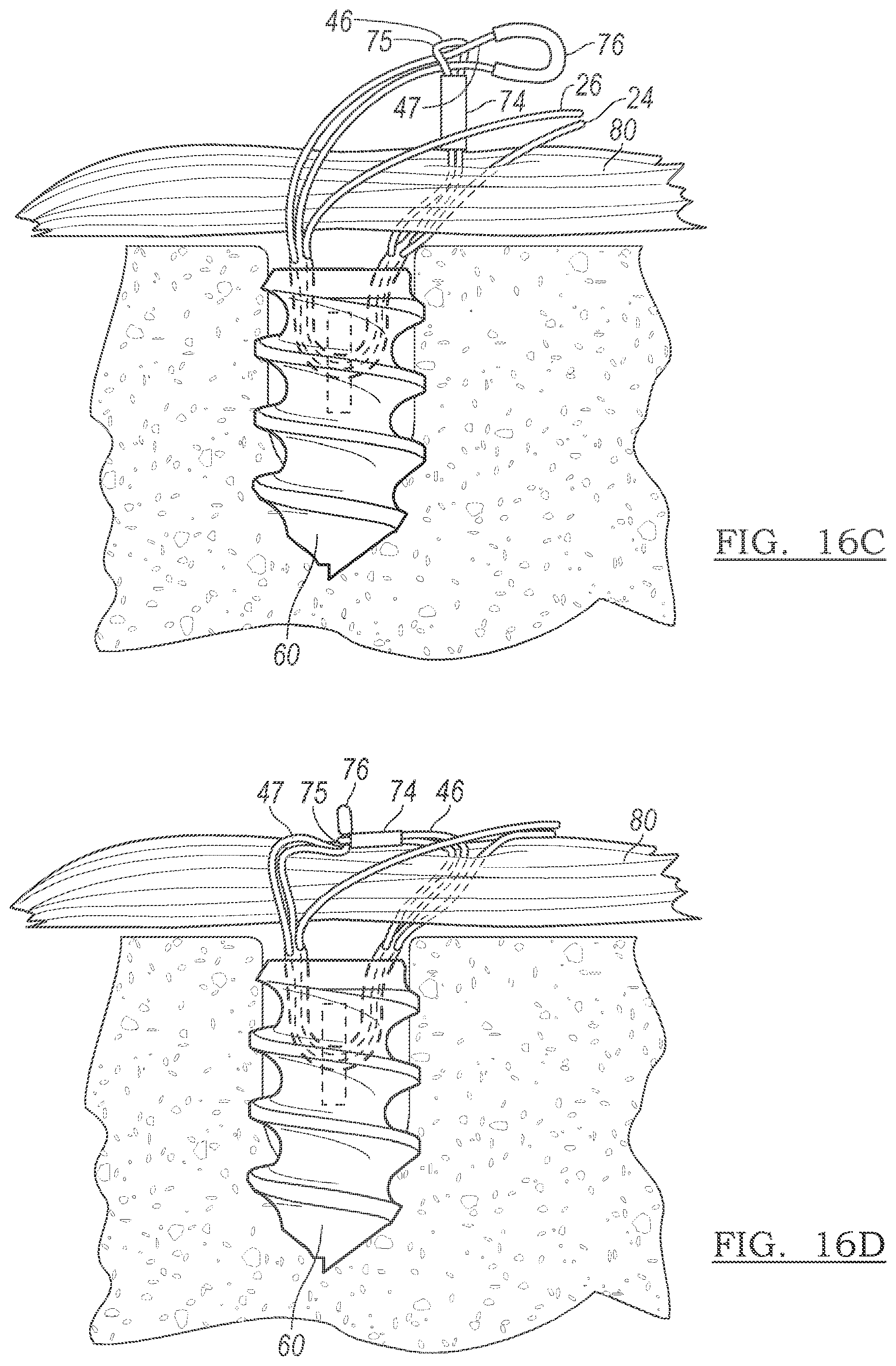 Patent US12096928 Figure 18 – Method and apparatus for coupling soft tissue to a bone