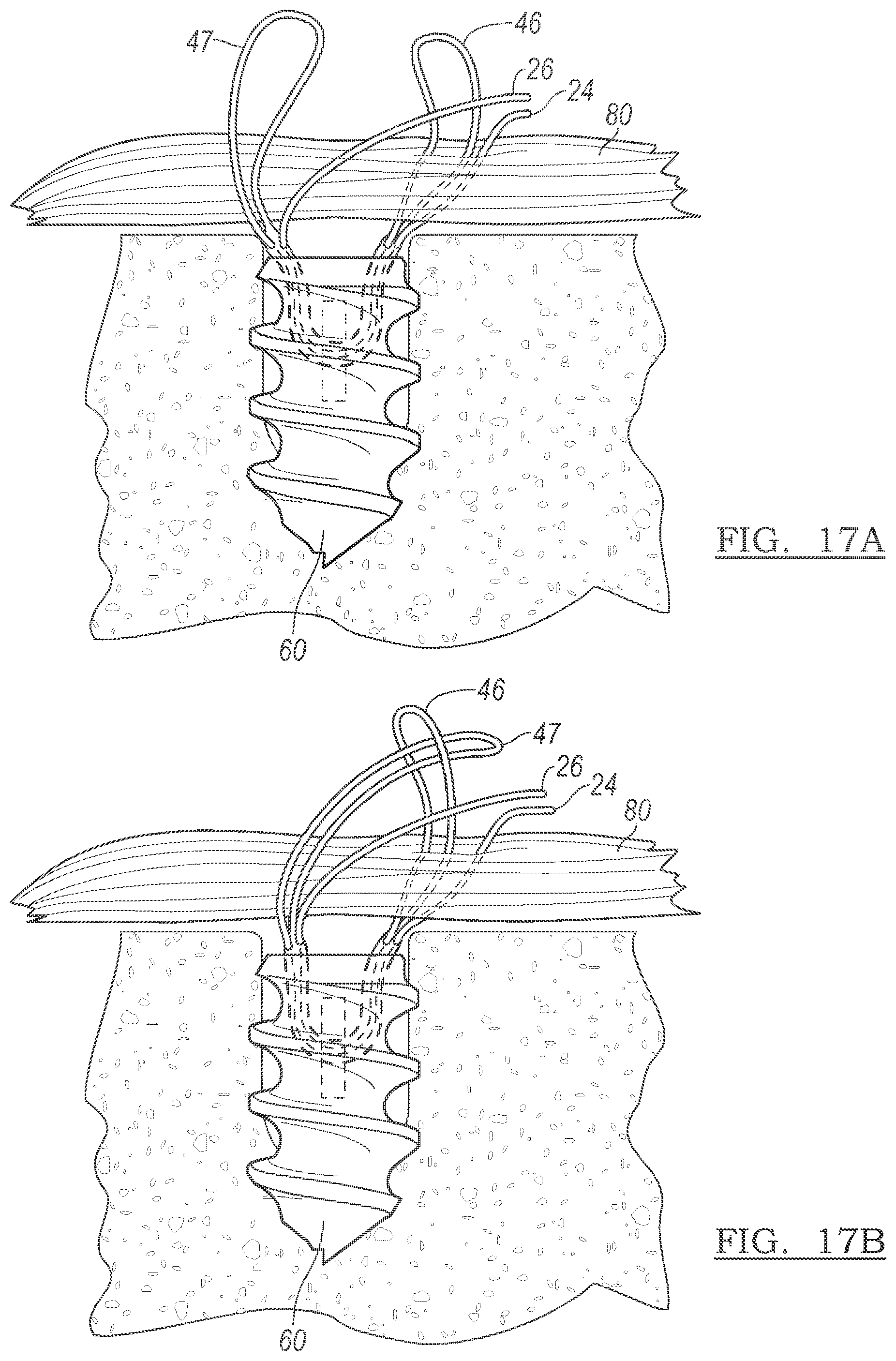 Patent US12096928 Figure 19 – Method and apparatus for coupling soft tissue to a bone