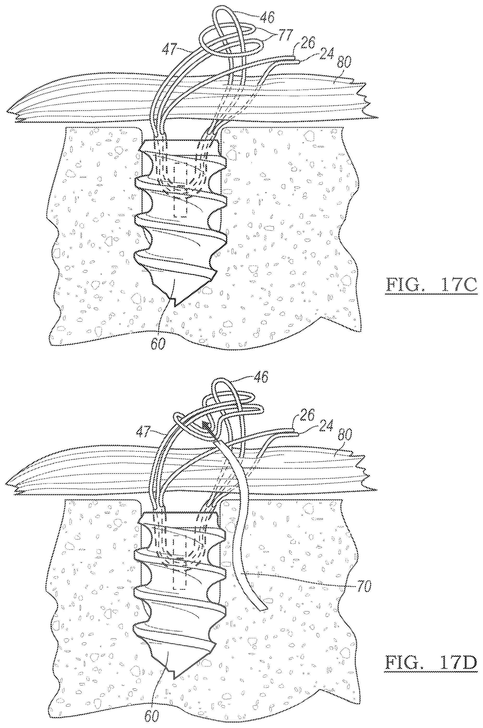 Patent US12096928 Figure 20 – Method and apparatus for coupling soft tissue to a bone