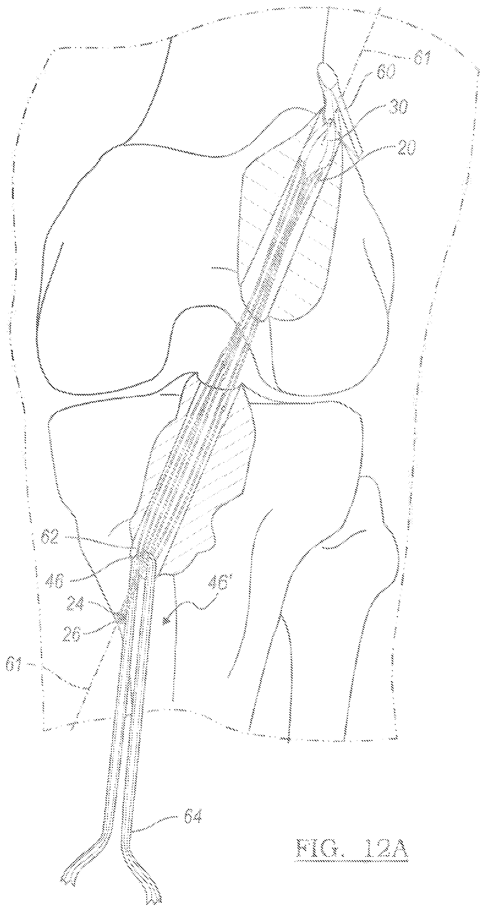 Patent US12096931 Figure 6 – Method and apparatus for coupling soft tissue to a bone