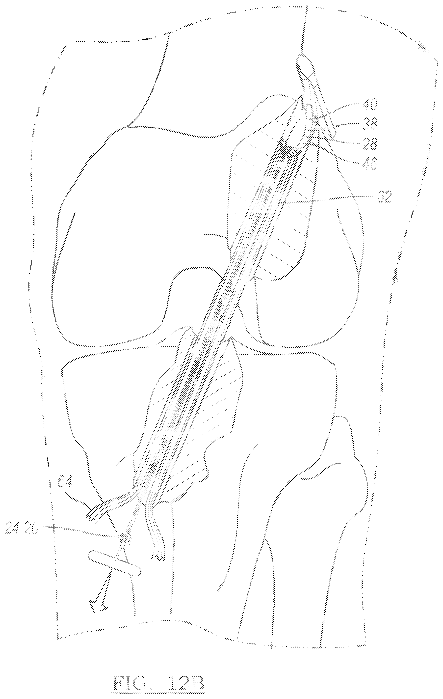 Patent US12096931 Figure 7 – Method and apparatus for coupling soft tissue to a bone