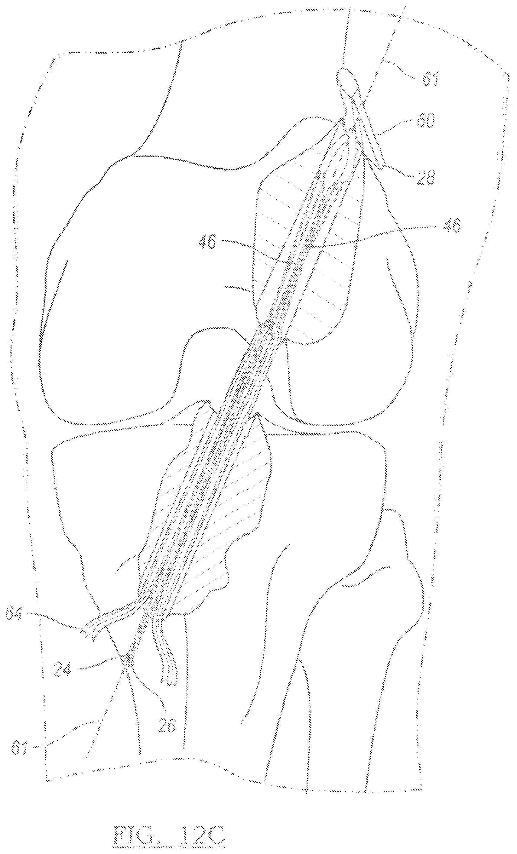 Patent US12096931 Figure 8 – Method and apparatus for coupling soft tissue to a bone