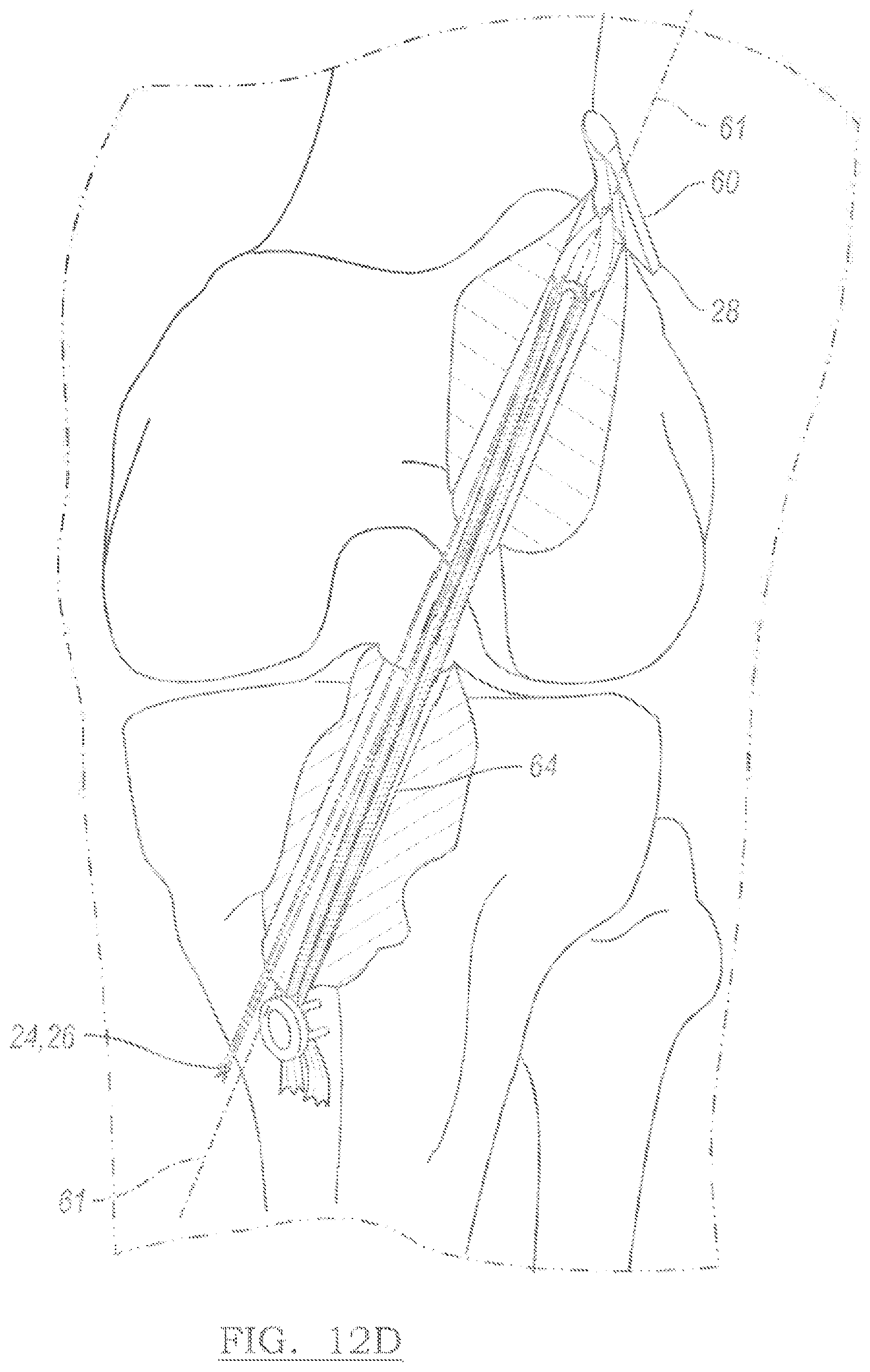Patent US12096931 Figure 9 – Method and apparatus for coupling soft tissue to a bone