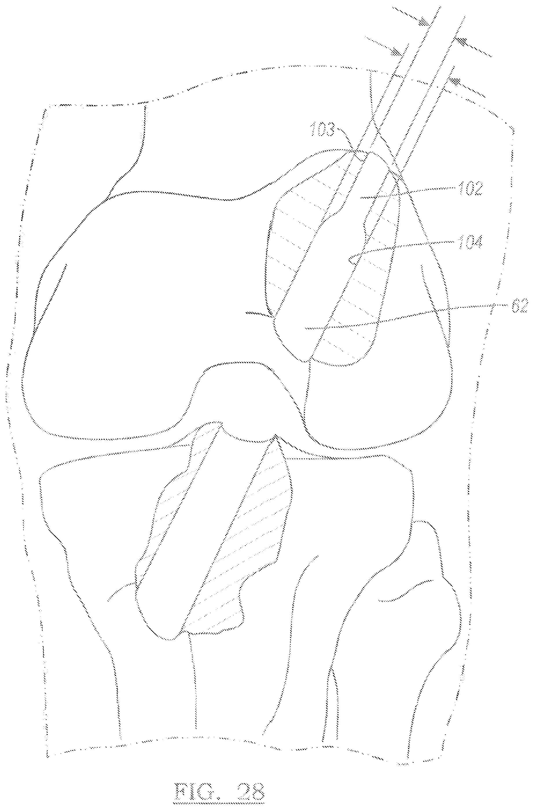 Patent US12096931 Figure 16 – Method and apparatus for coupling soft tissue to a bone