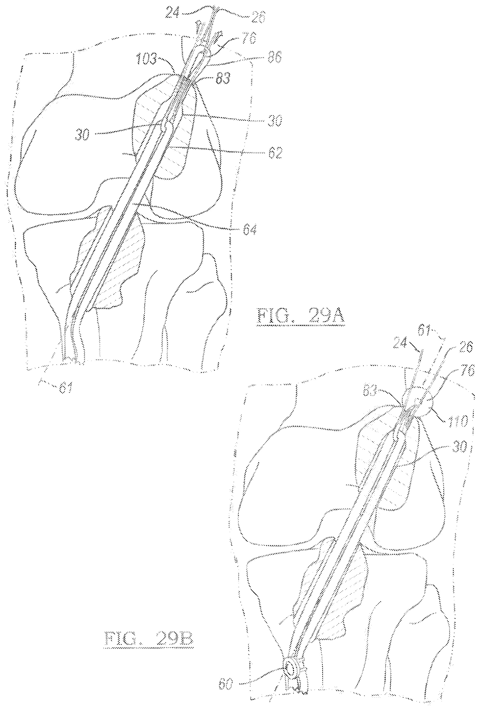 Patent US12096931 Figure 17 – Method and apparatus for coupling soft tissue to a bone