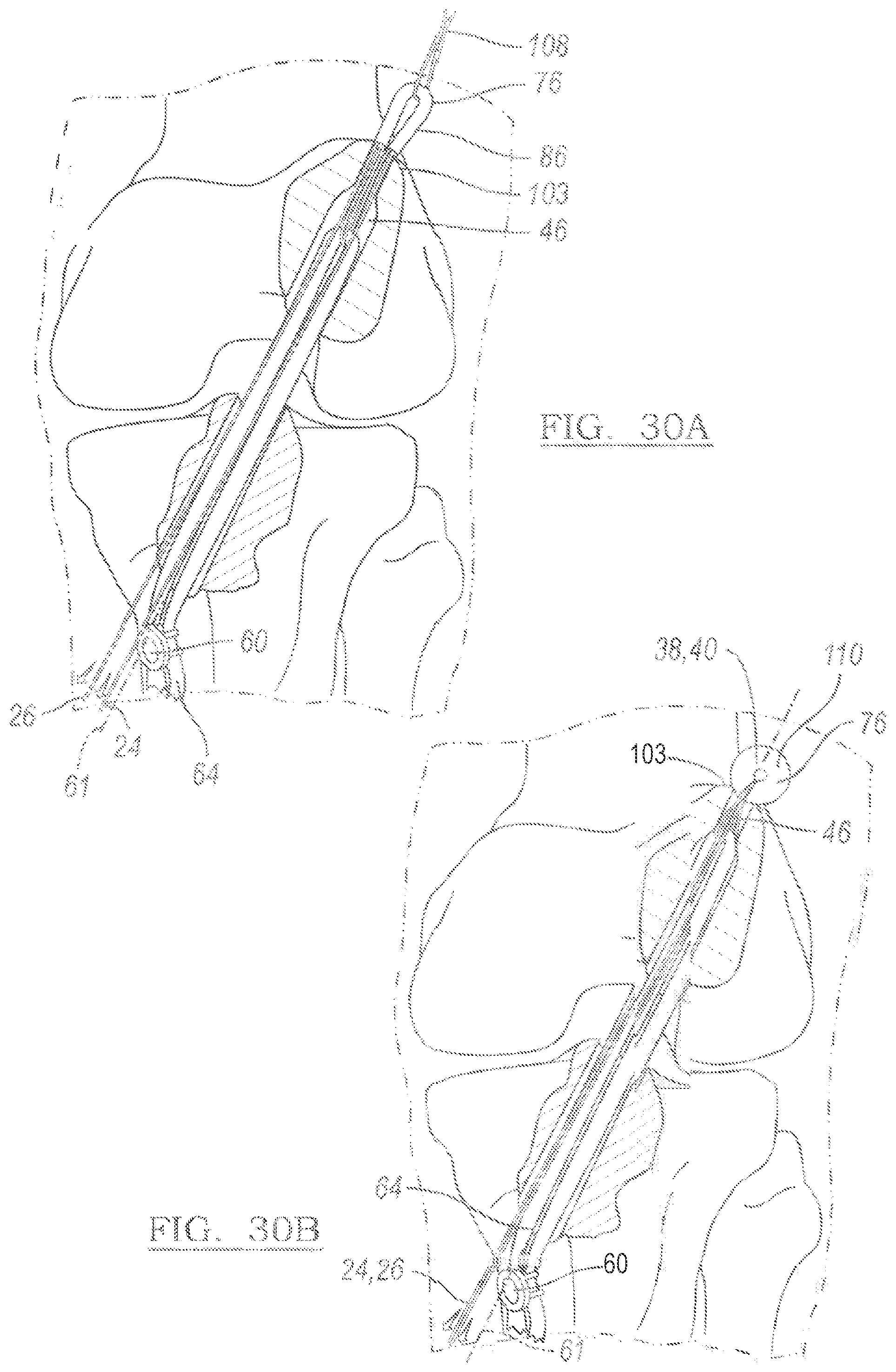 Patent US12096931 Figure 18 – Method and apparatus for coupling soft tissue to a bone