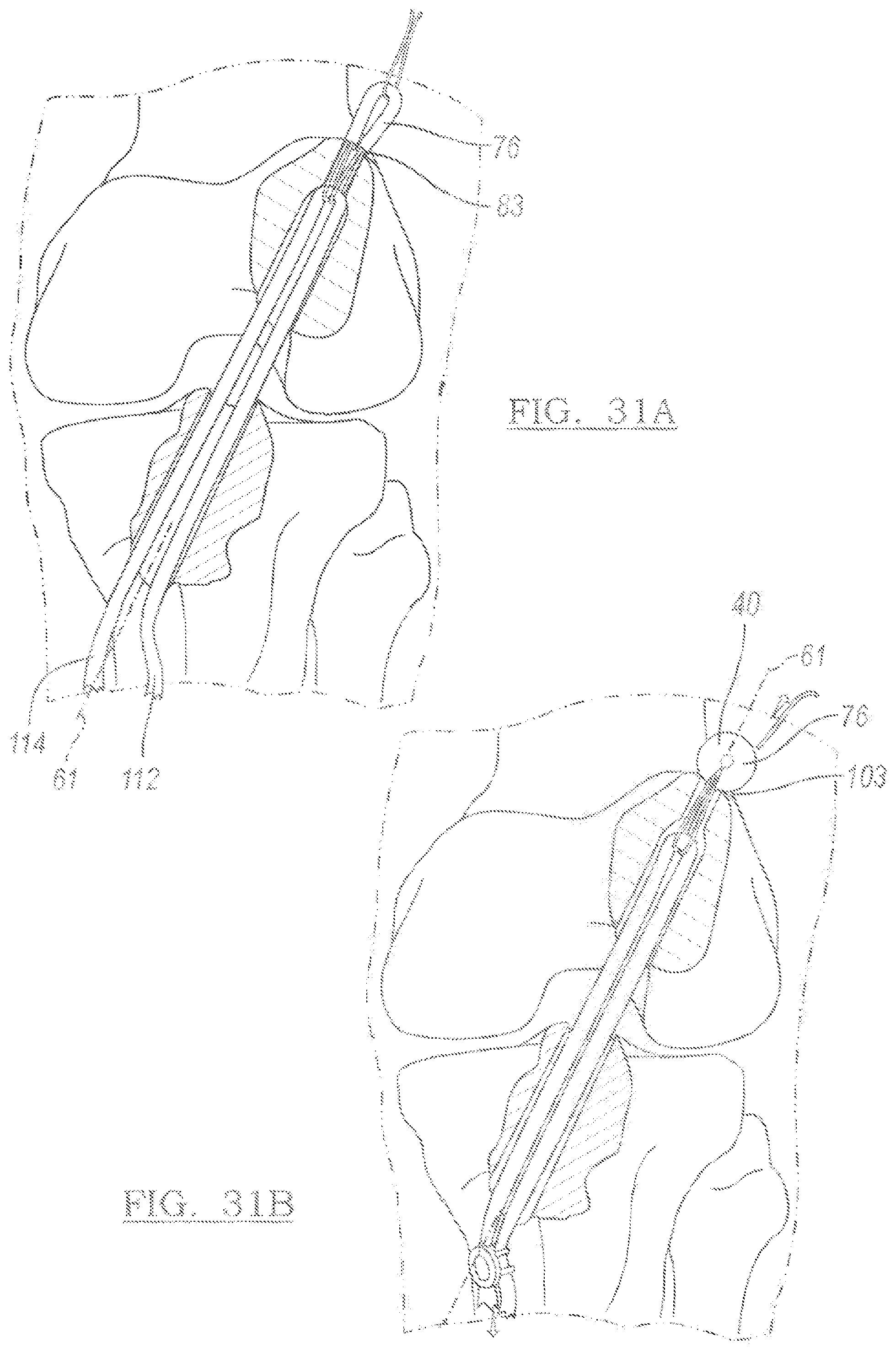 Patent US12096931 Figure 19 – Method and apparatus for coupling soft tissue to a bone
