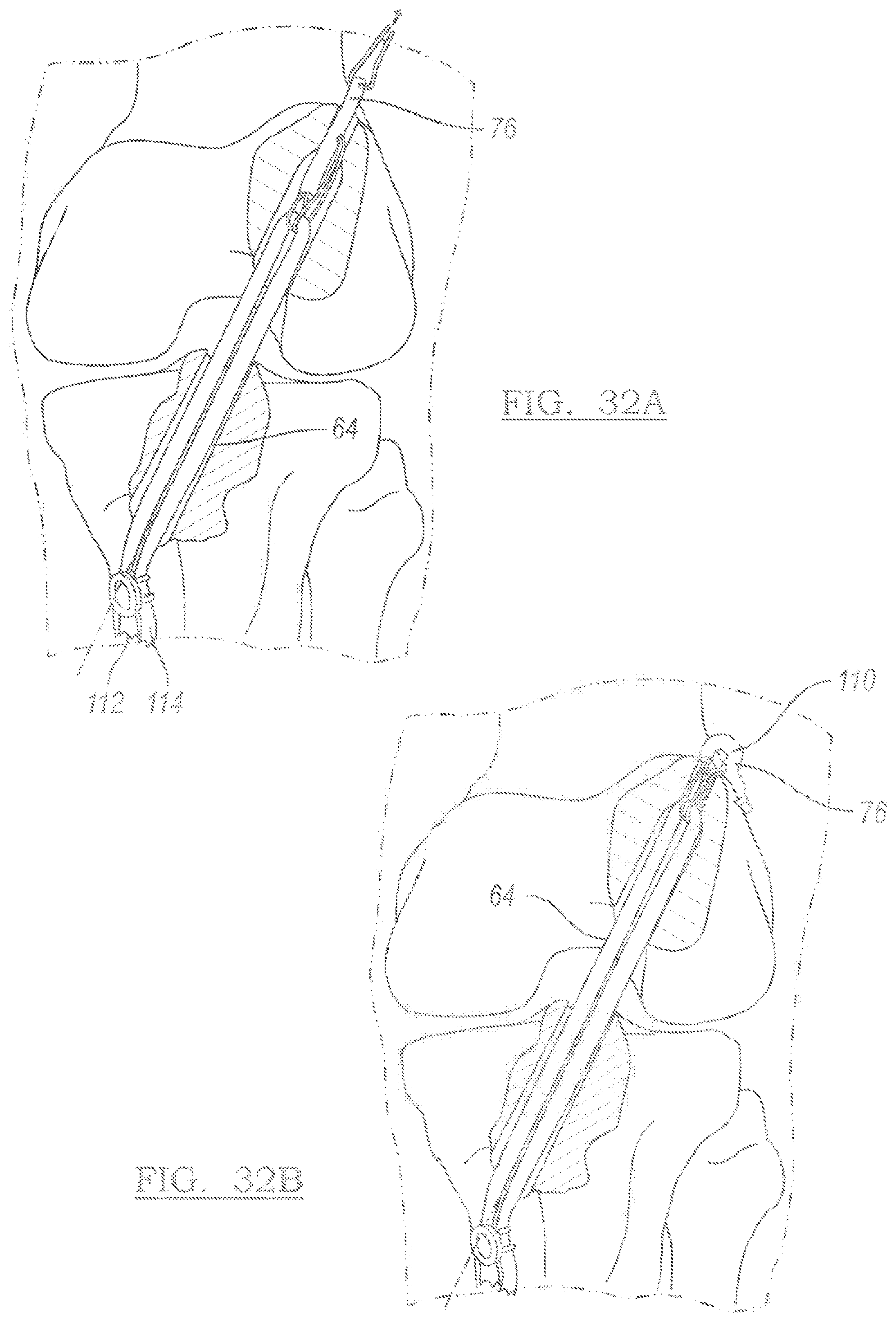 Patent US12096931 Figure 20 – Method and apparatus for coupling soft tissue to a bone