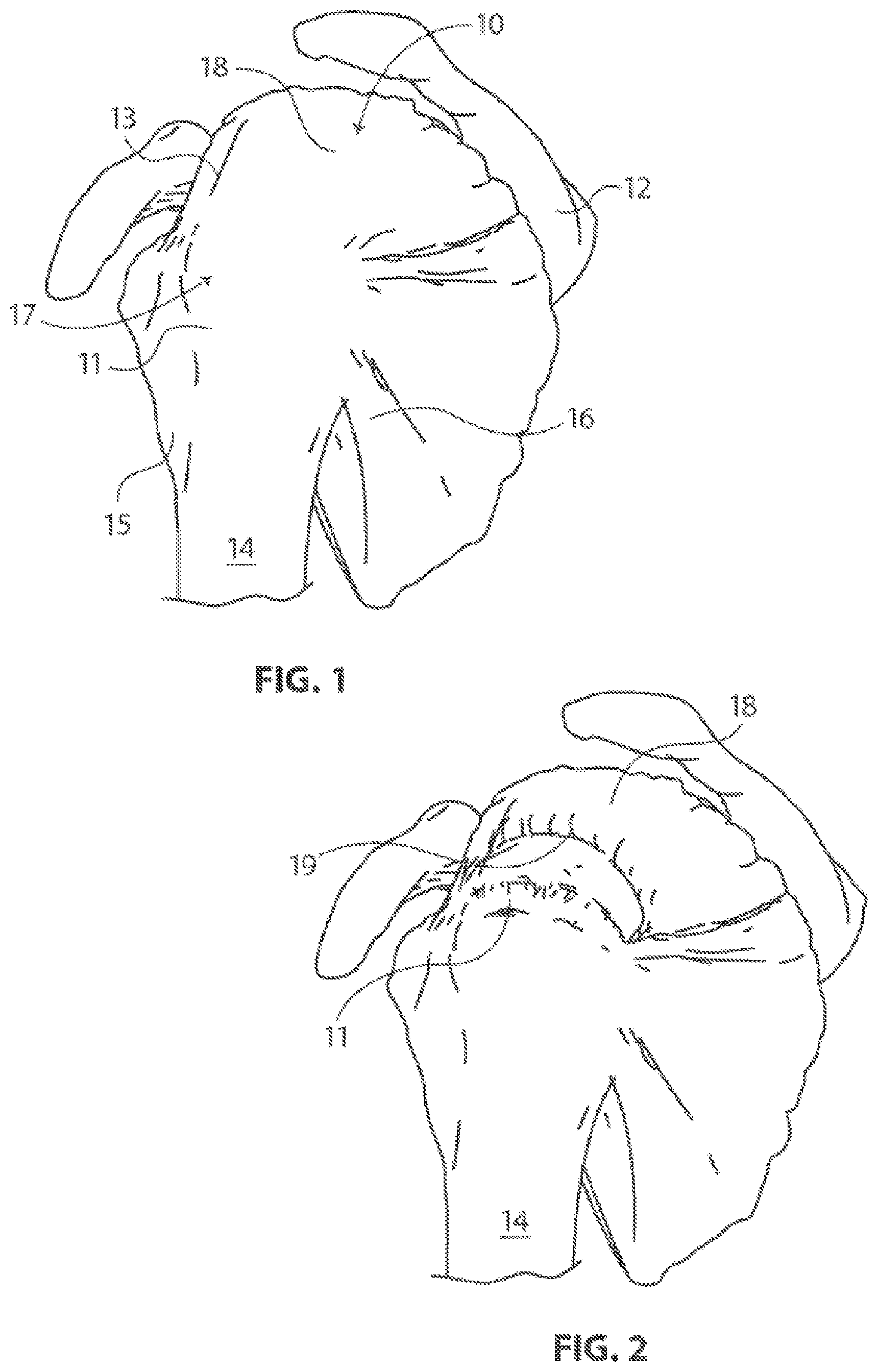 Patent US12096932 Figure 1 – Medical implant delivery system and related methods
