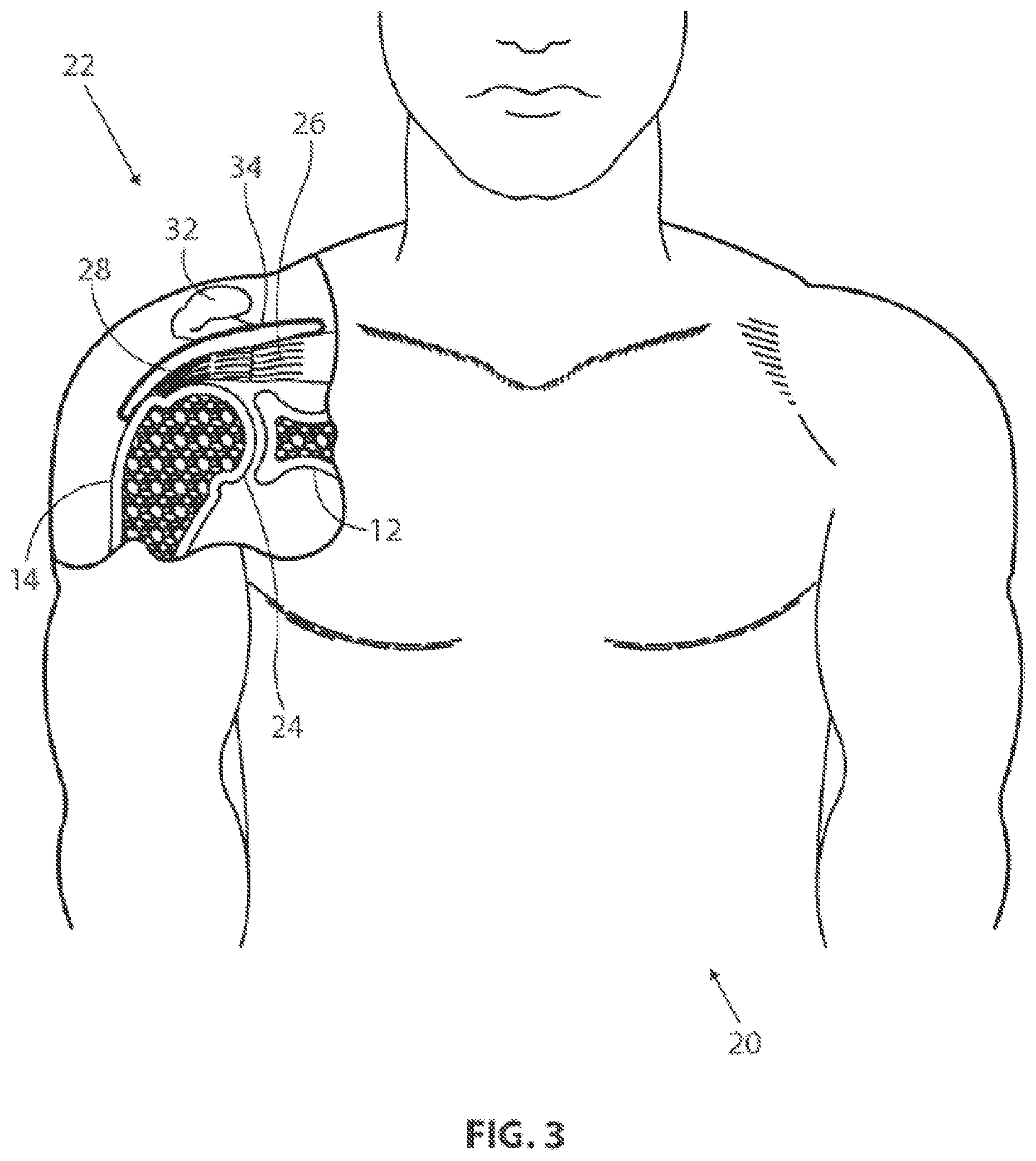 Patent US12096932 Figure 2 – Medical implant delivery system and related methods
