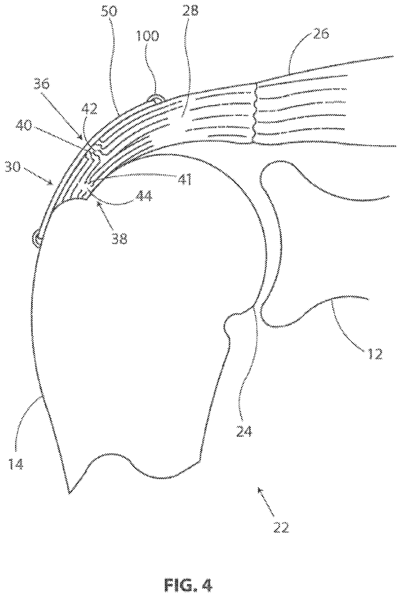 Patent US12096932 Figure 3 – Medical implant delivery system and related methods