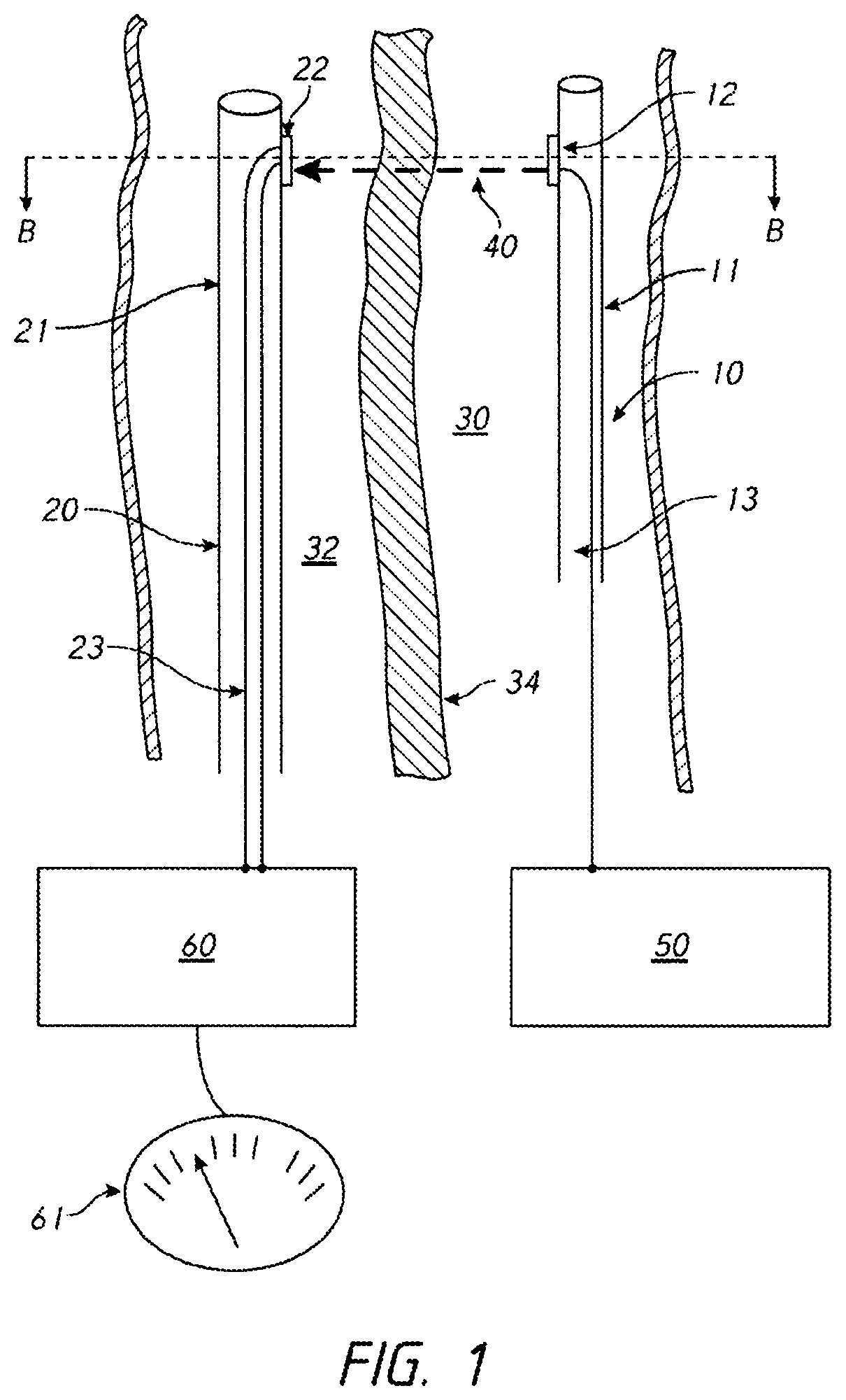 Patent US12096938 Figure 1 – Devices and methods for increasing blood perfusion to a distal extremity