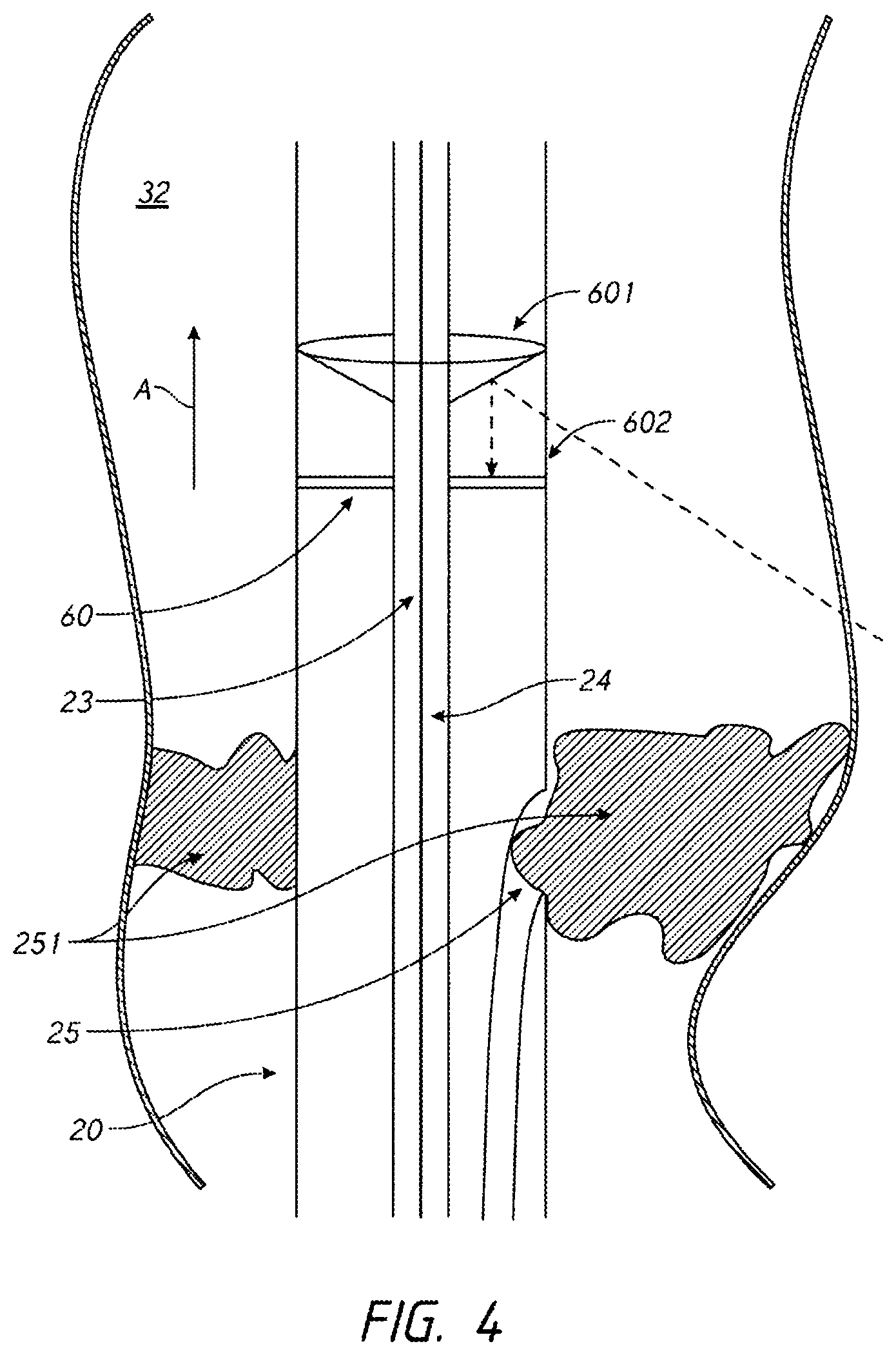 Patent US12096938 Figure 4 – Devices and methods for increasing blood perfusion to a distal extremity