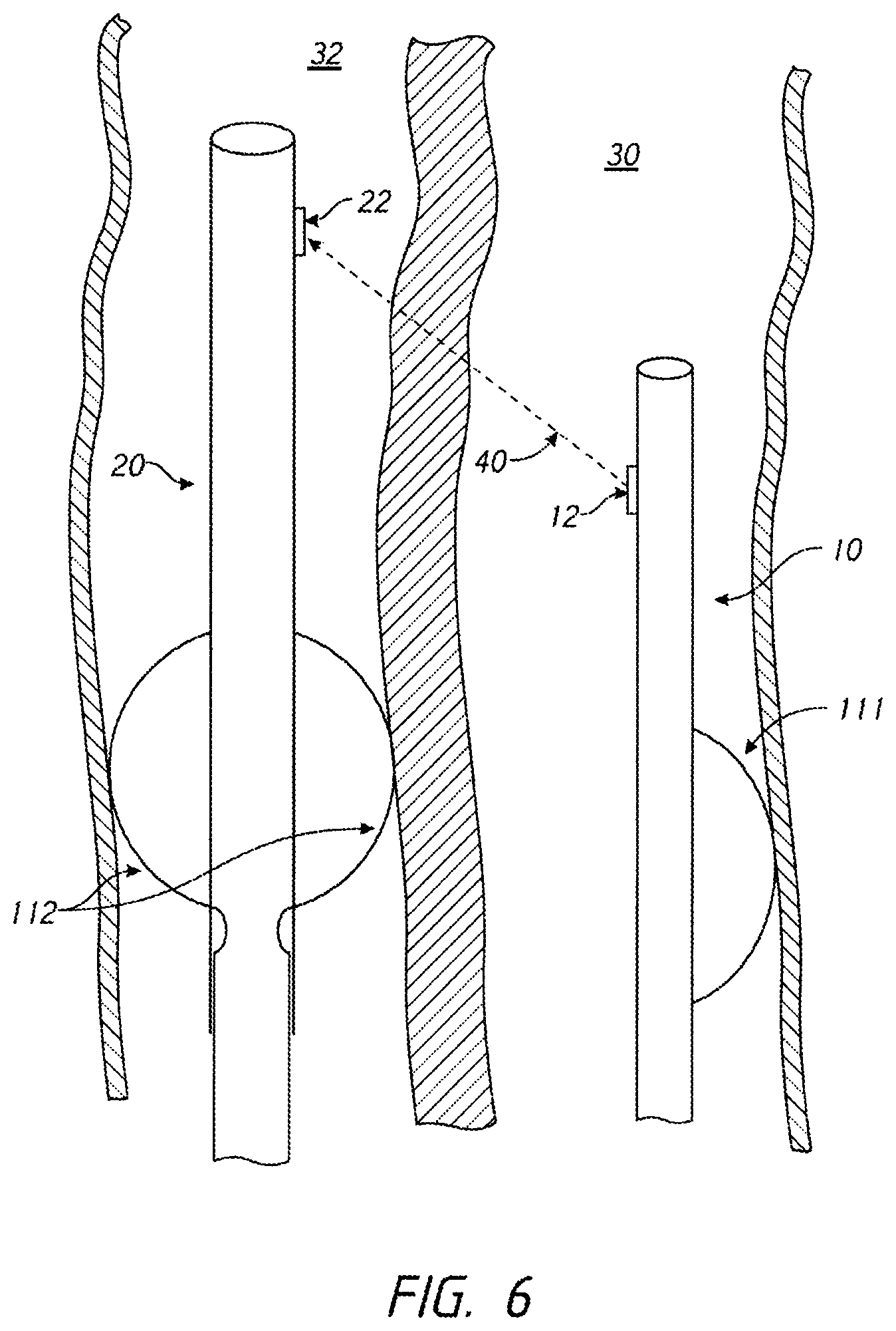 Patent US12096938 Figure 6 – Devices and methods for increasing blood perfusion to a distal extremity