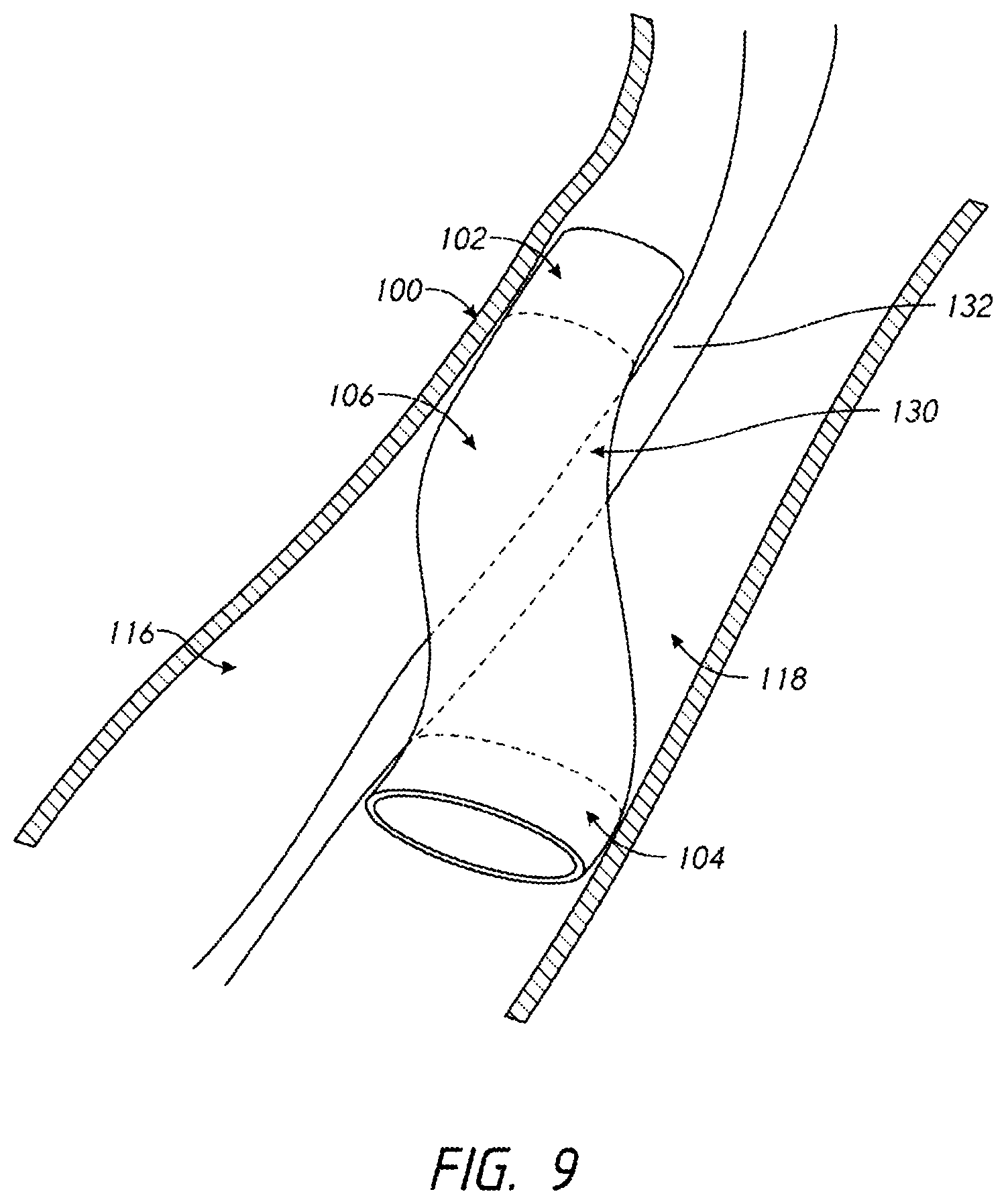 Patent US12096938 Figure 9 – Devices and methods for increasing blood perfusion to a distal extremity