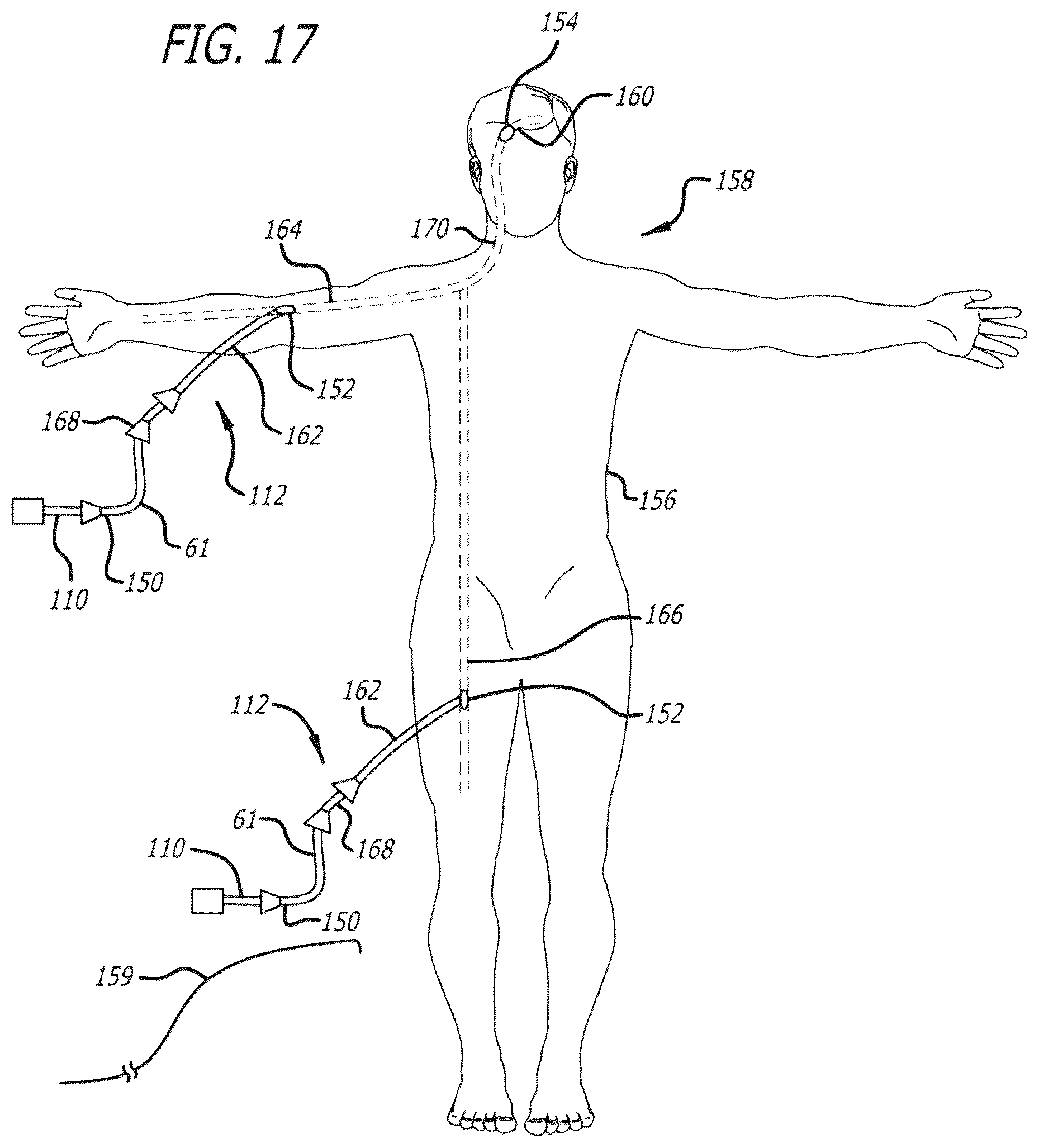 Patent US12096940 Figure 12 – Filamentary devices for treatment of vascular defects