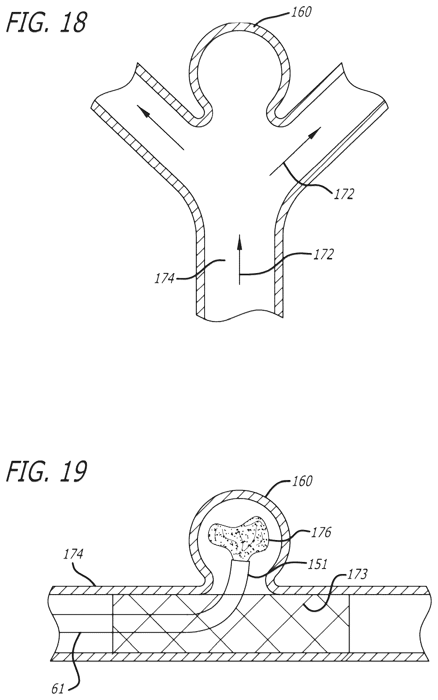 Patent US12096940 Figure 13 – Filamentary devices for treatment of vascular defects