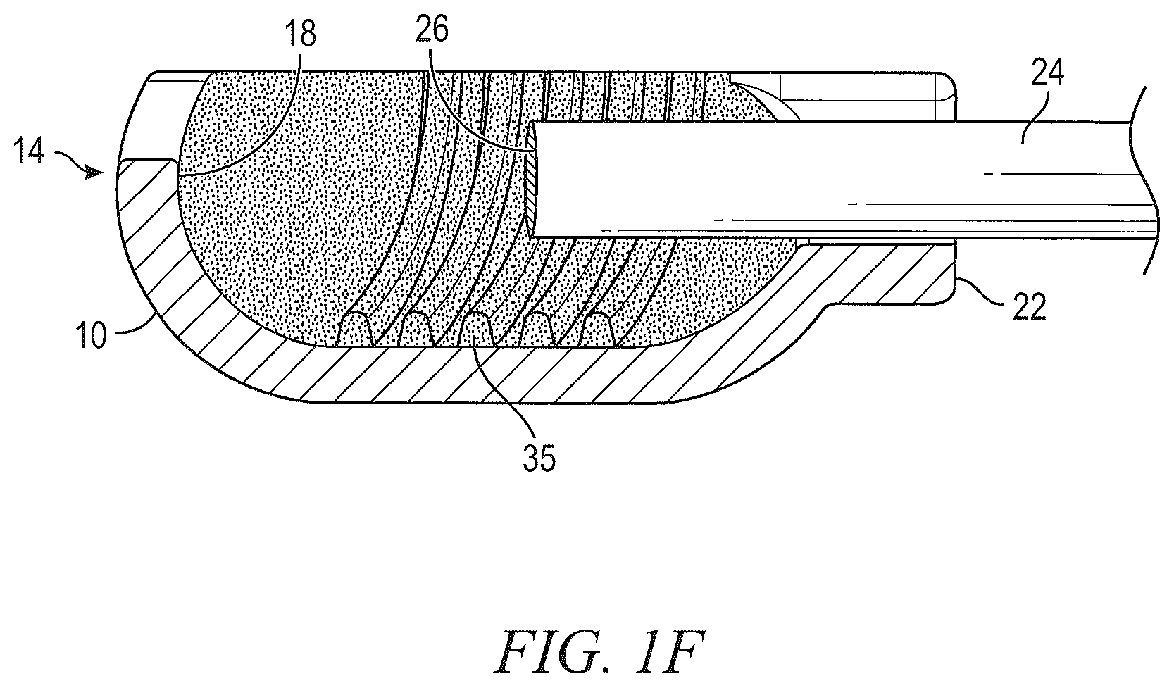 Patent US12096941 Figure 4 – Methods for forming a nerve barrier