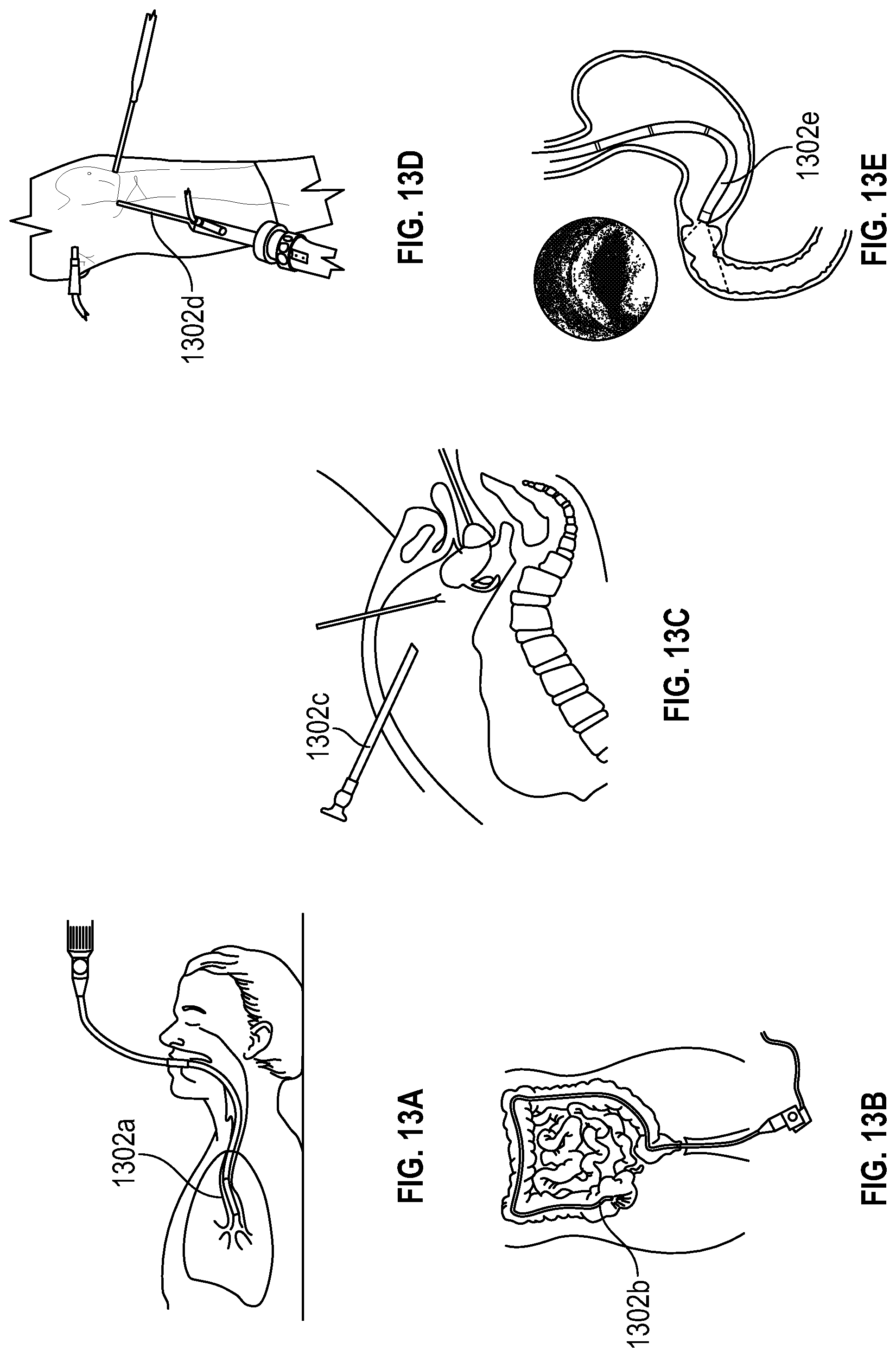 Patent US12096945 Figure 11 – Systems and devices for endoscopic procedure analysis based on state data