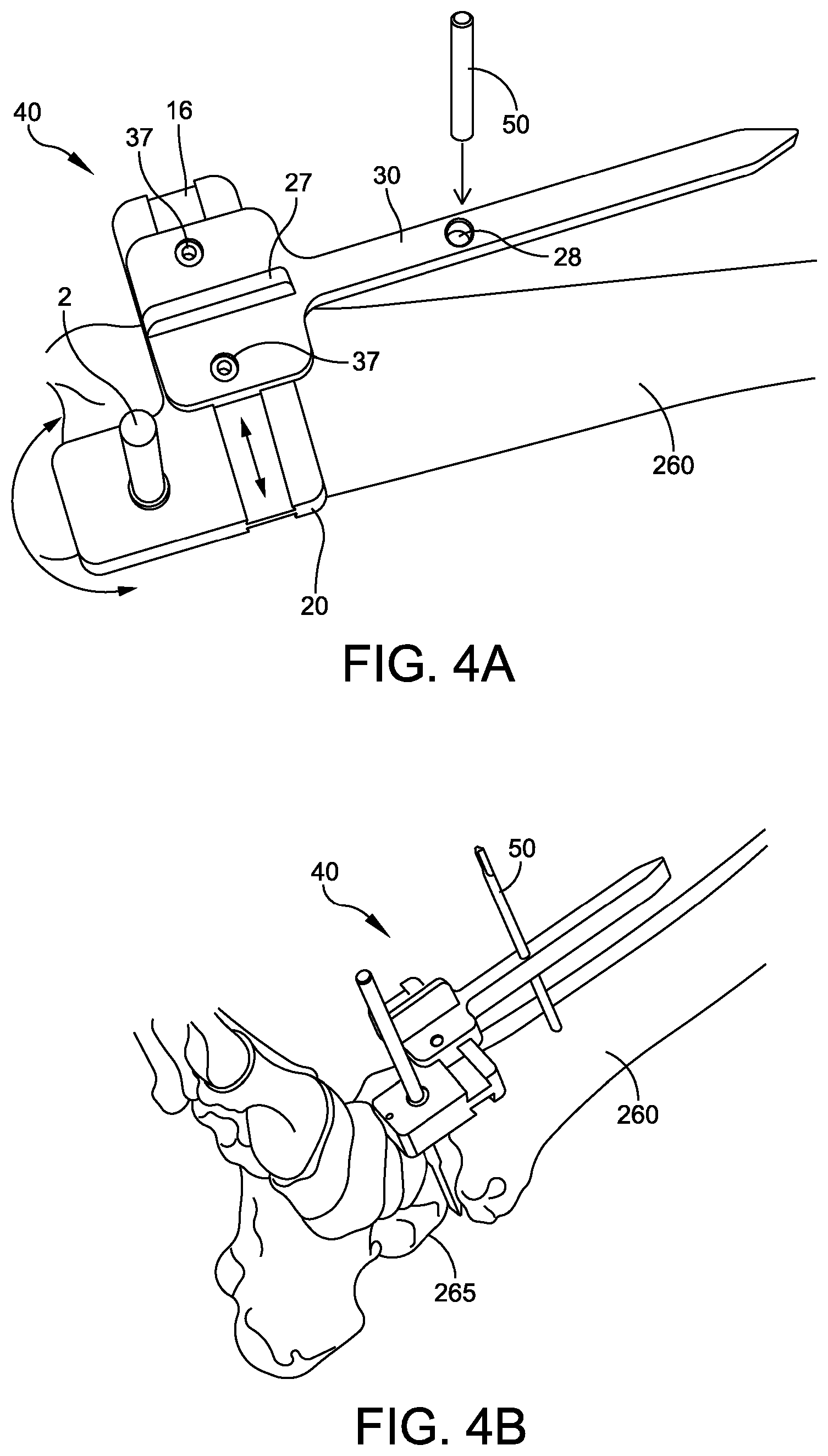 Patent US12096948 Figure 6 – Ankle replacement system and method