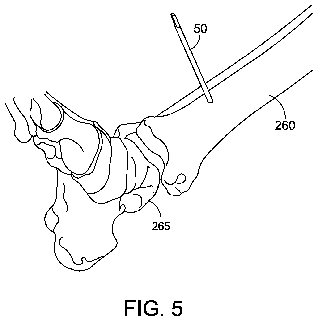Patent US12096948 Figure 7 – Ankle replacement system and method