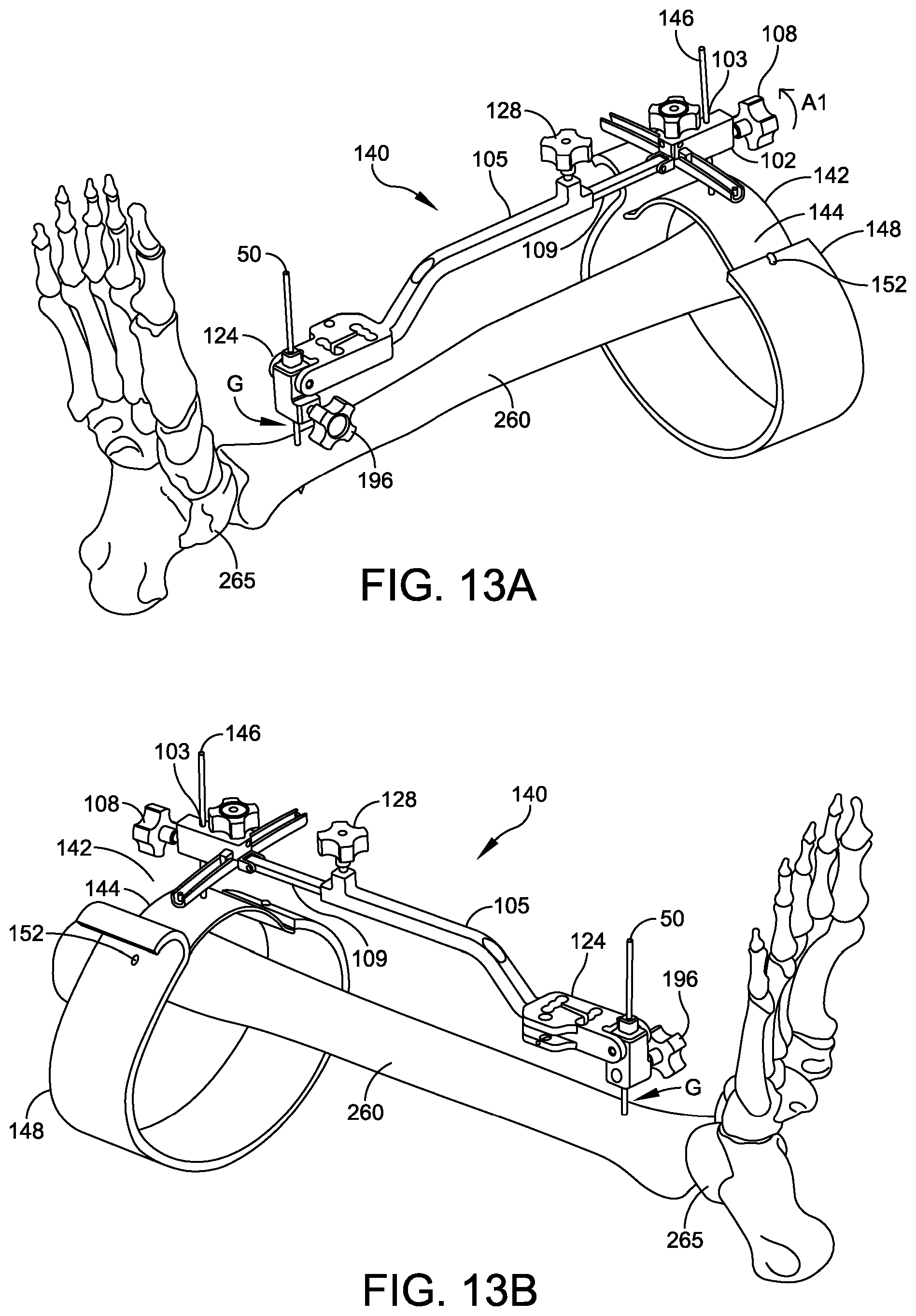 Patent US12096948 Figure 12 – Ankle replacement system and method