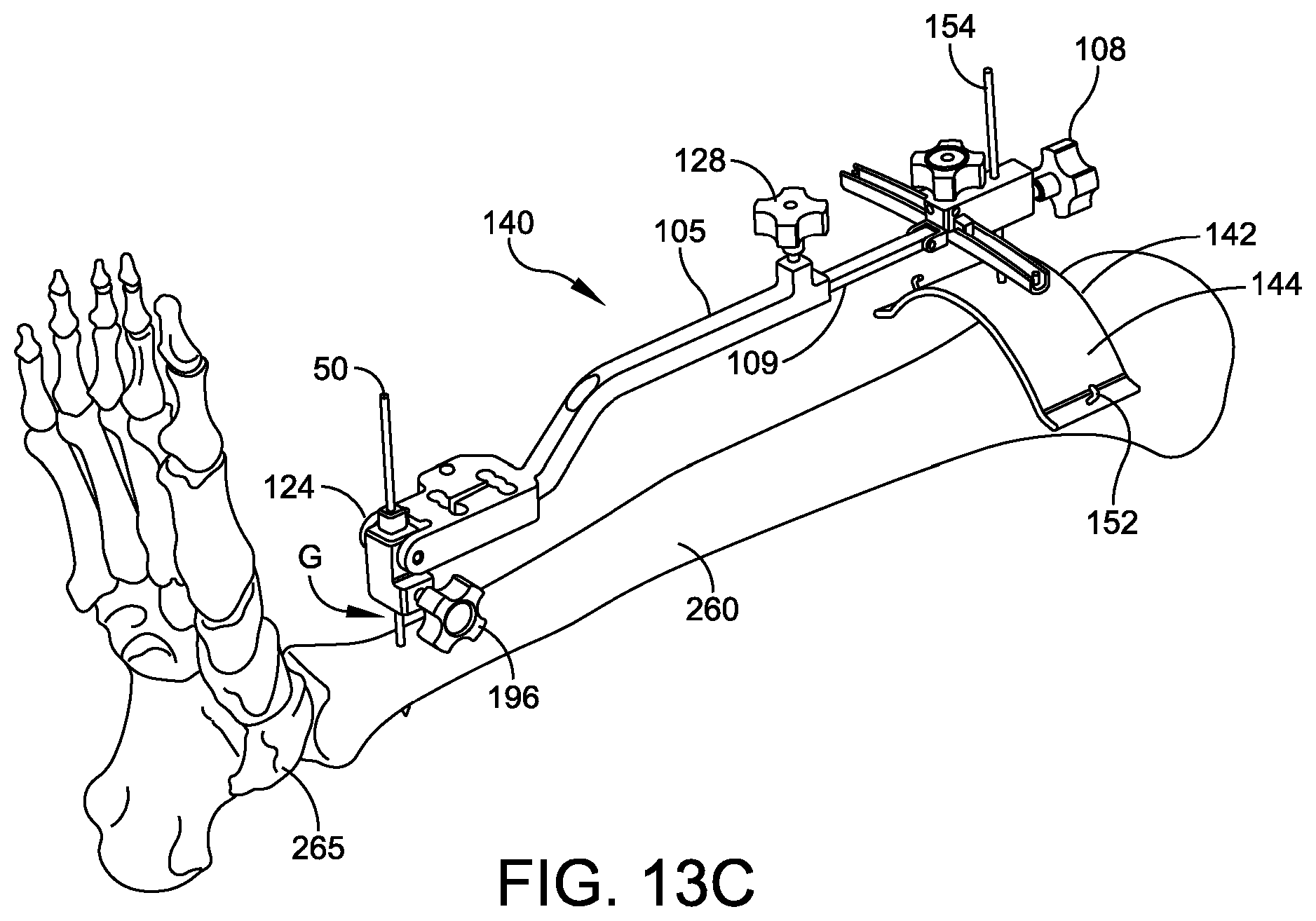 Patent US12096948 Figure 13 – Ankle replacement system and method